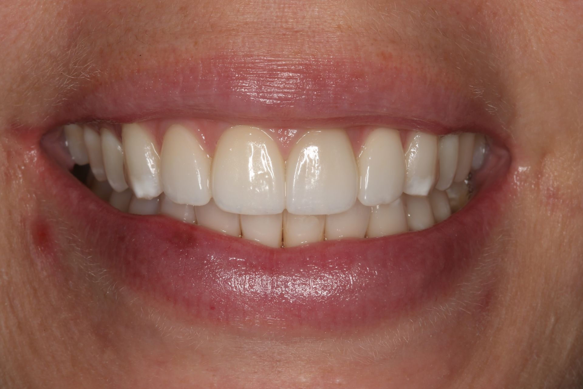 A close-up of a person's smile, showing straight, white teeth and healthy gums.