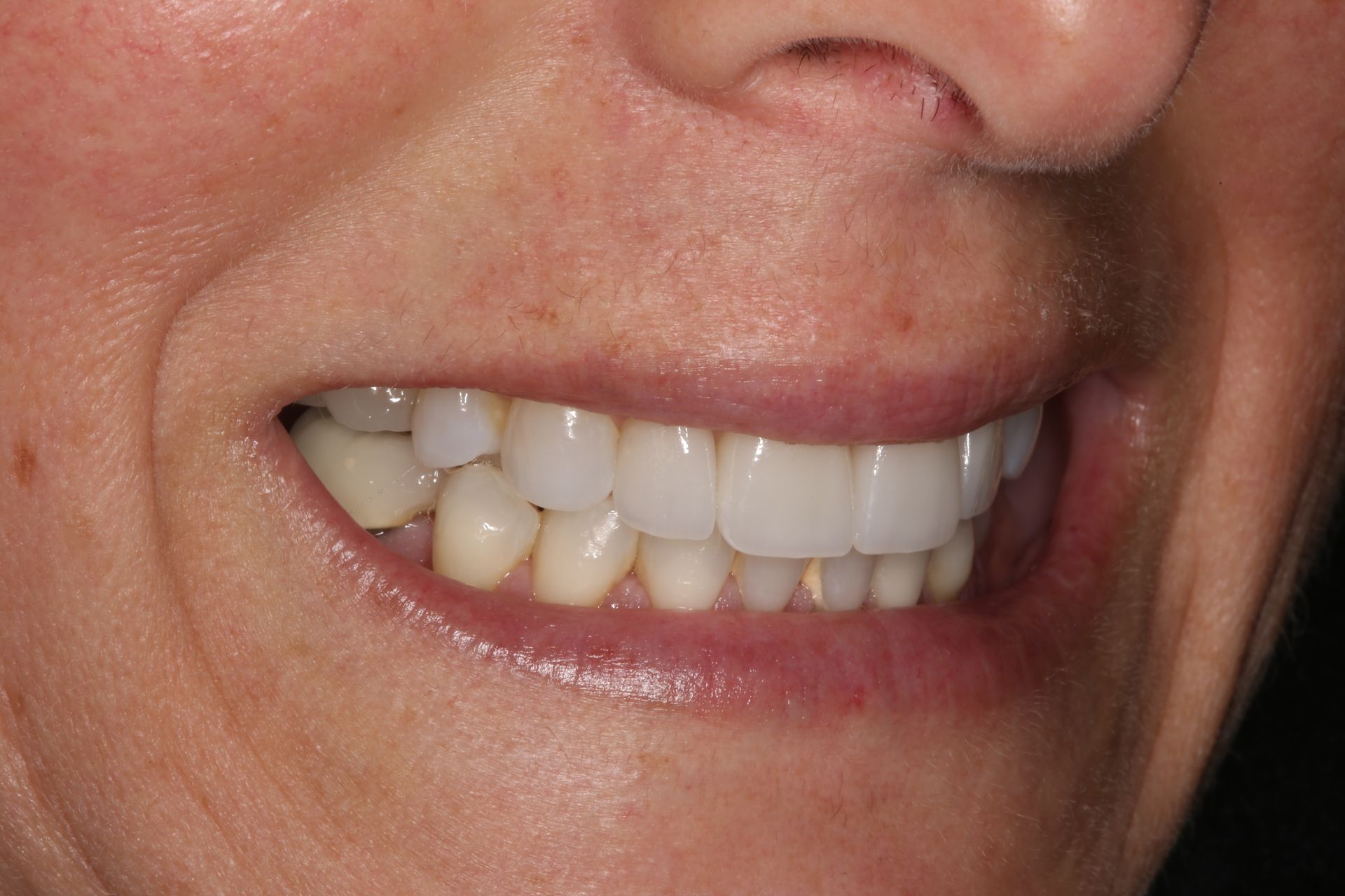A close-up view of a smiling mouth displaying a mix of bright white and more natural, slightly yellowed teeth.