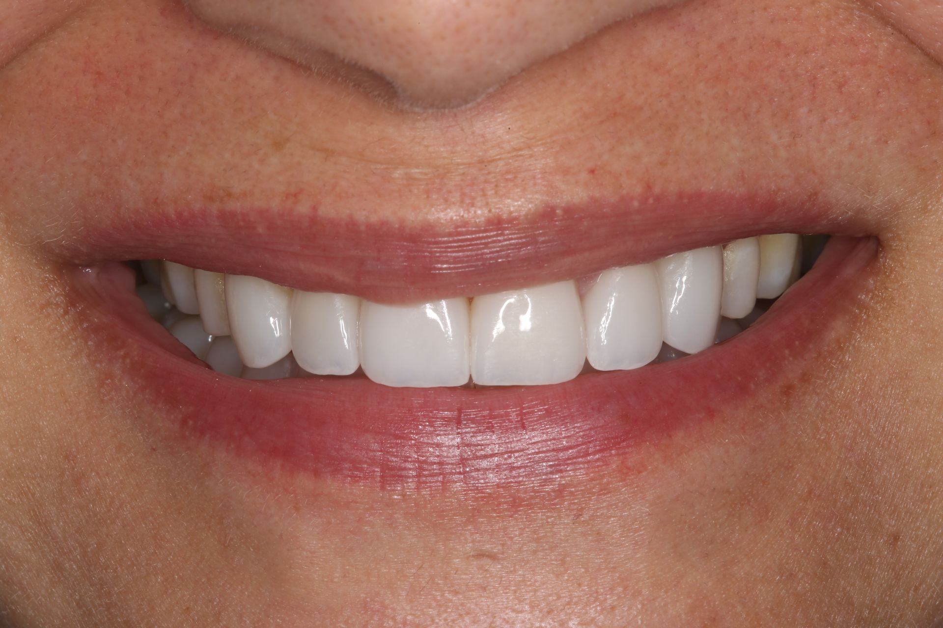 A close-up of a person's mouth and lower face, showing a straight, bright white smile with healthy-looking teeth.