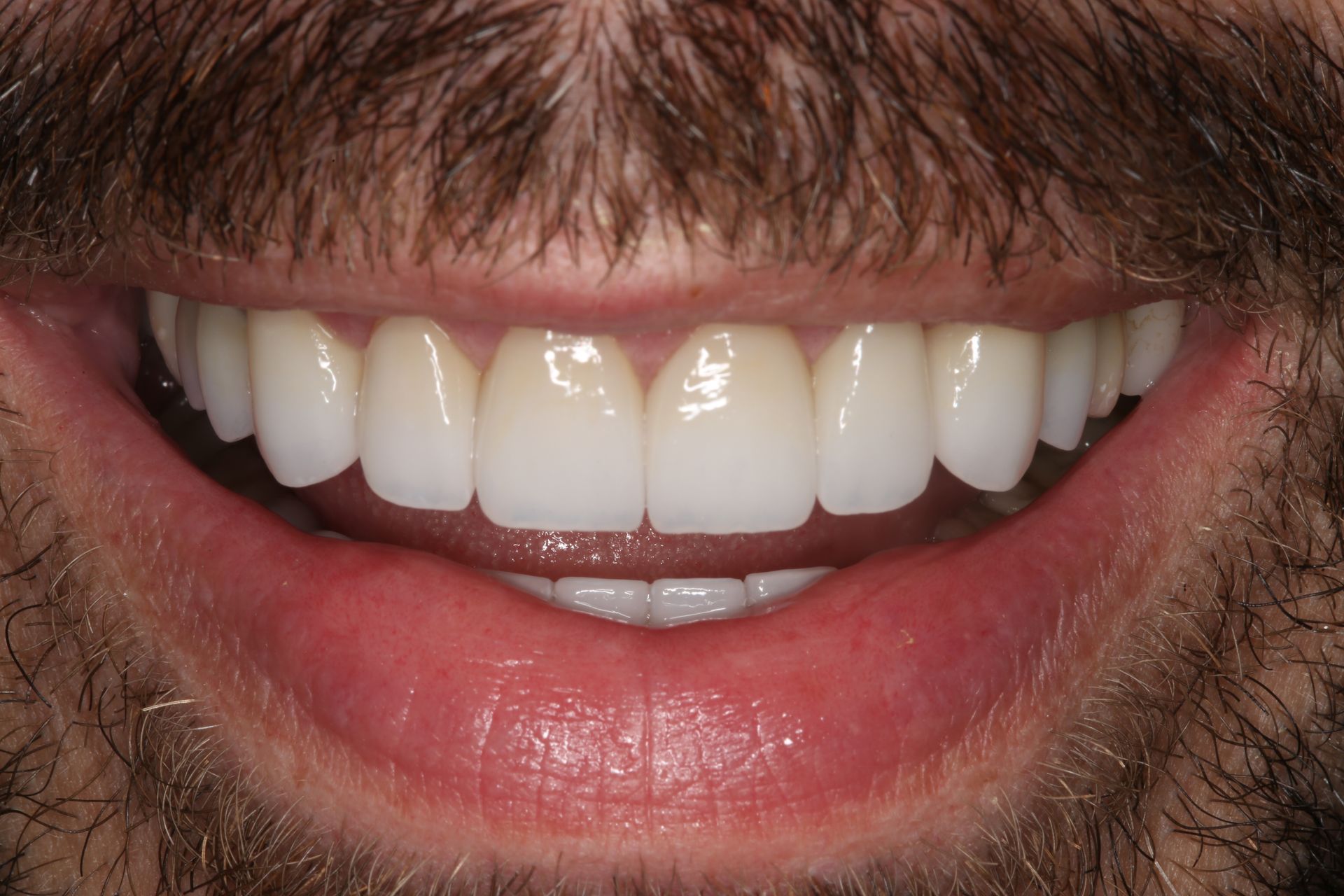 A close-up of a person's mouth displaying a set of white, uniform upper teeth while smiling.