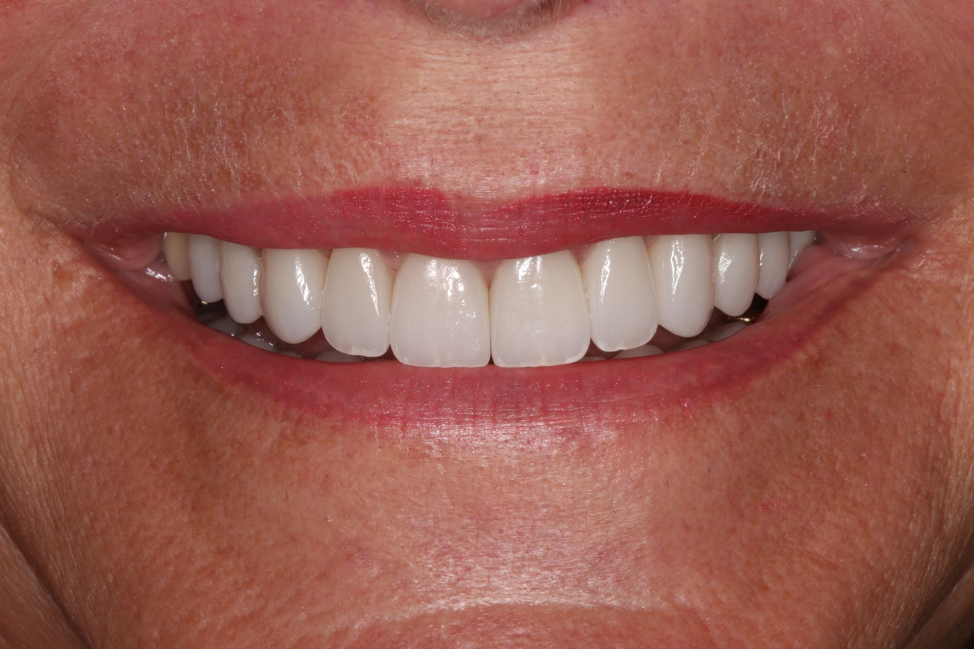 A close-up of a person smiling, highlighting a straight, white, and healthy set of top teeth.