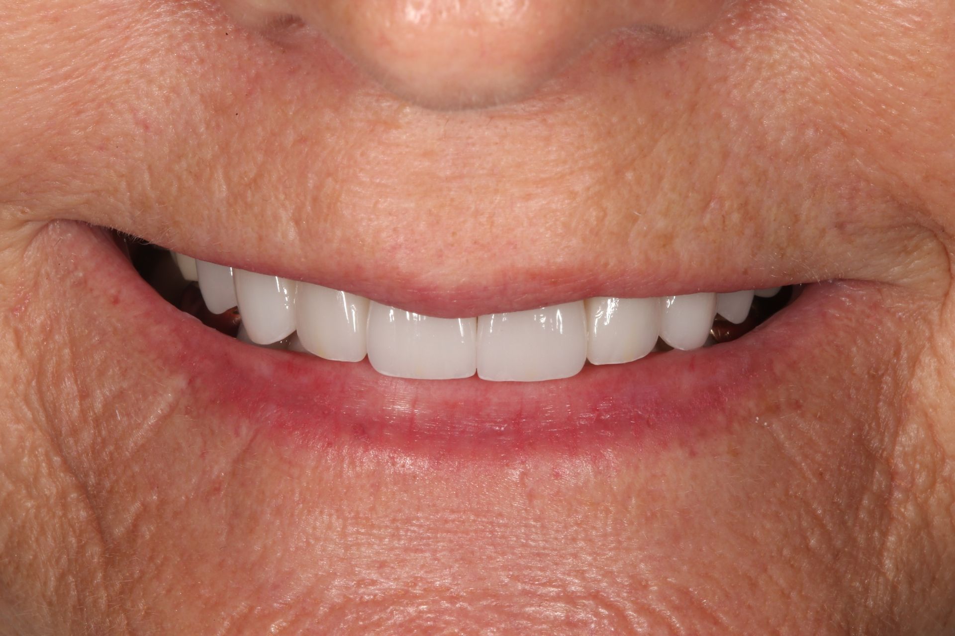 A close-up view of a smiling mouth showing straight, bright white upper teeth.