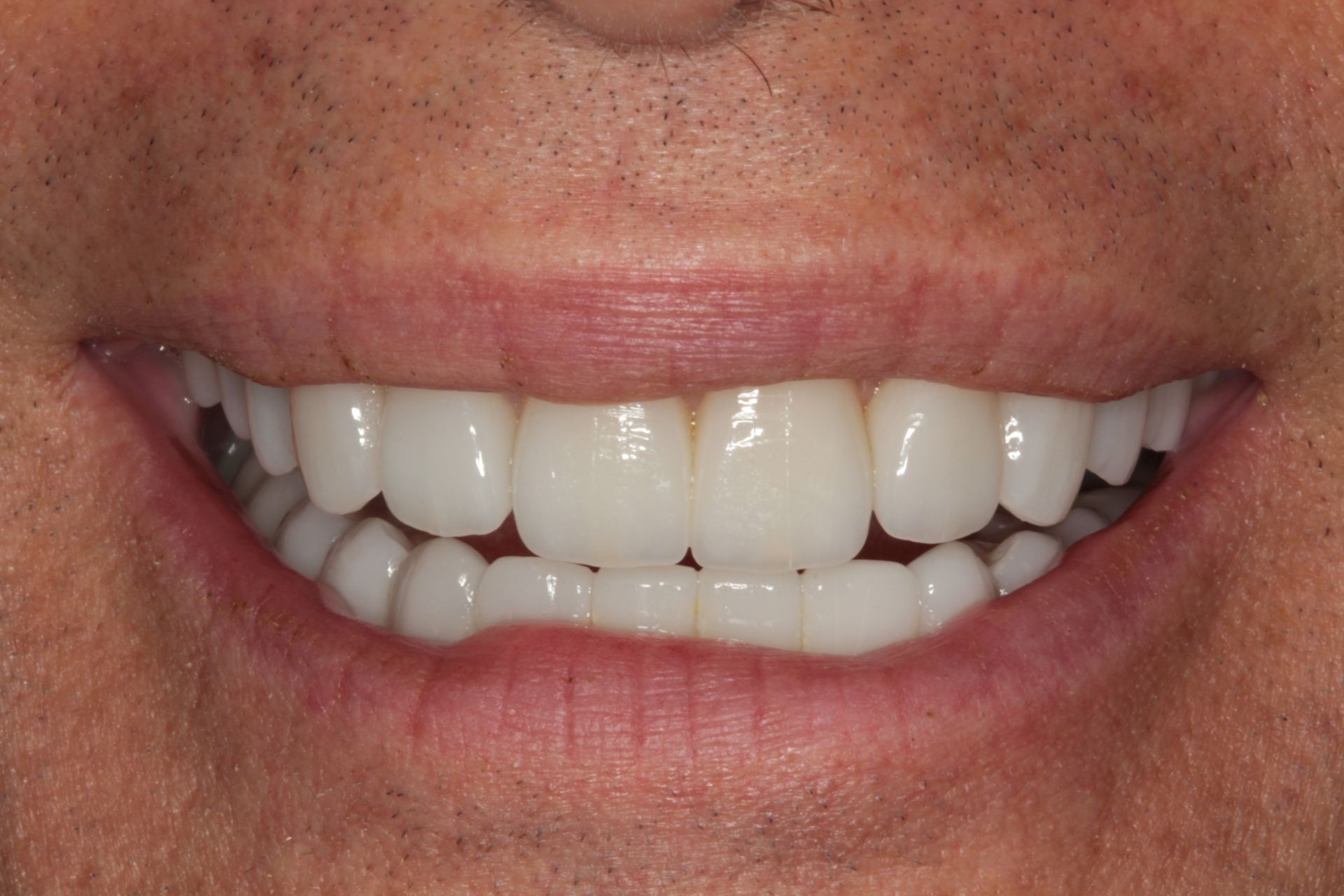 A close-up of a person's mouth with white, straight teeth smiling, showing top and bottom rows.