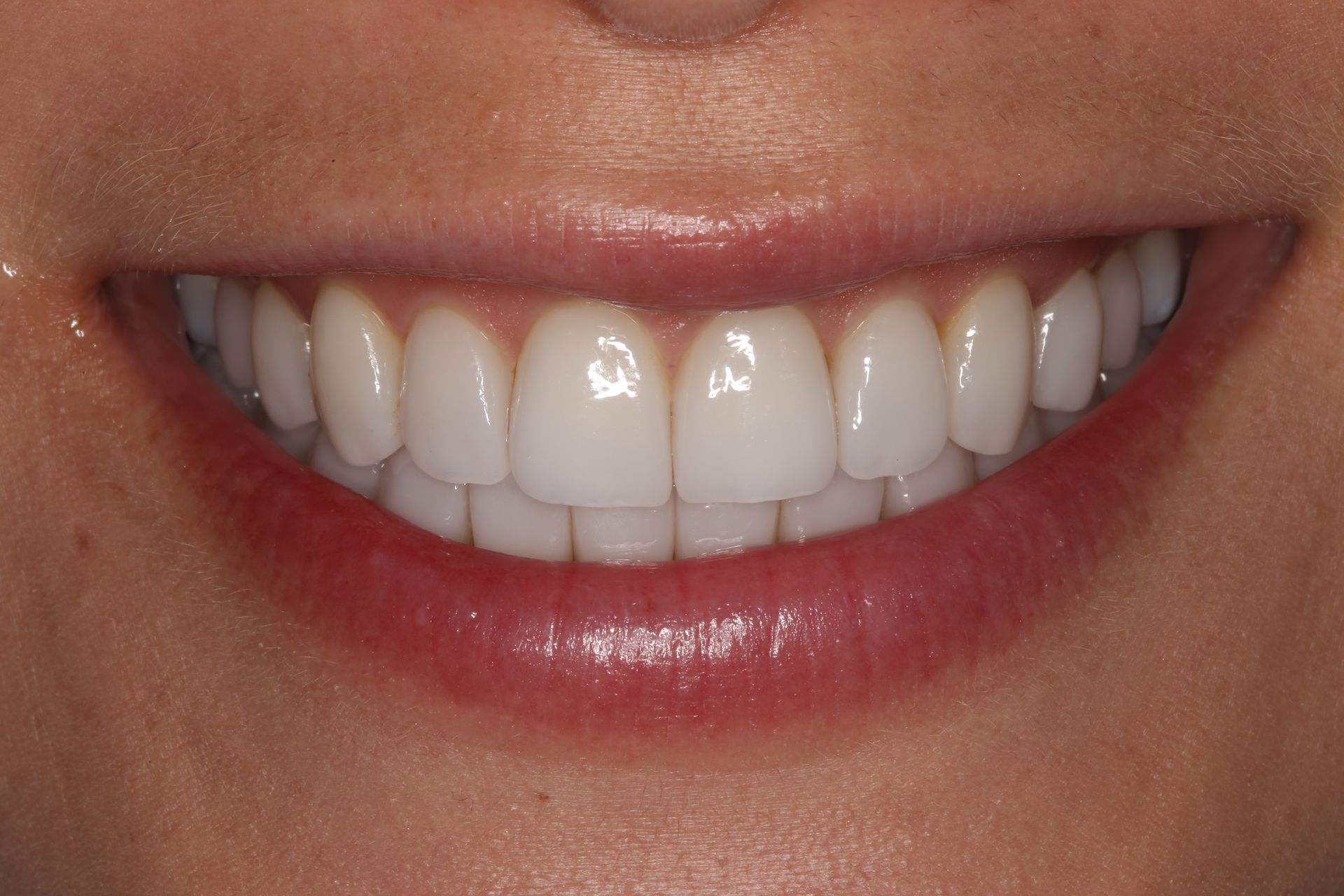 Close-up view of a person’s bright white smile, showing clean, aligned teeth and healthy gums.