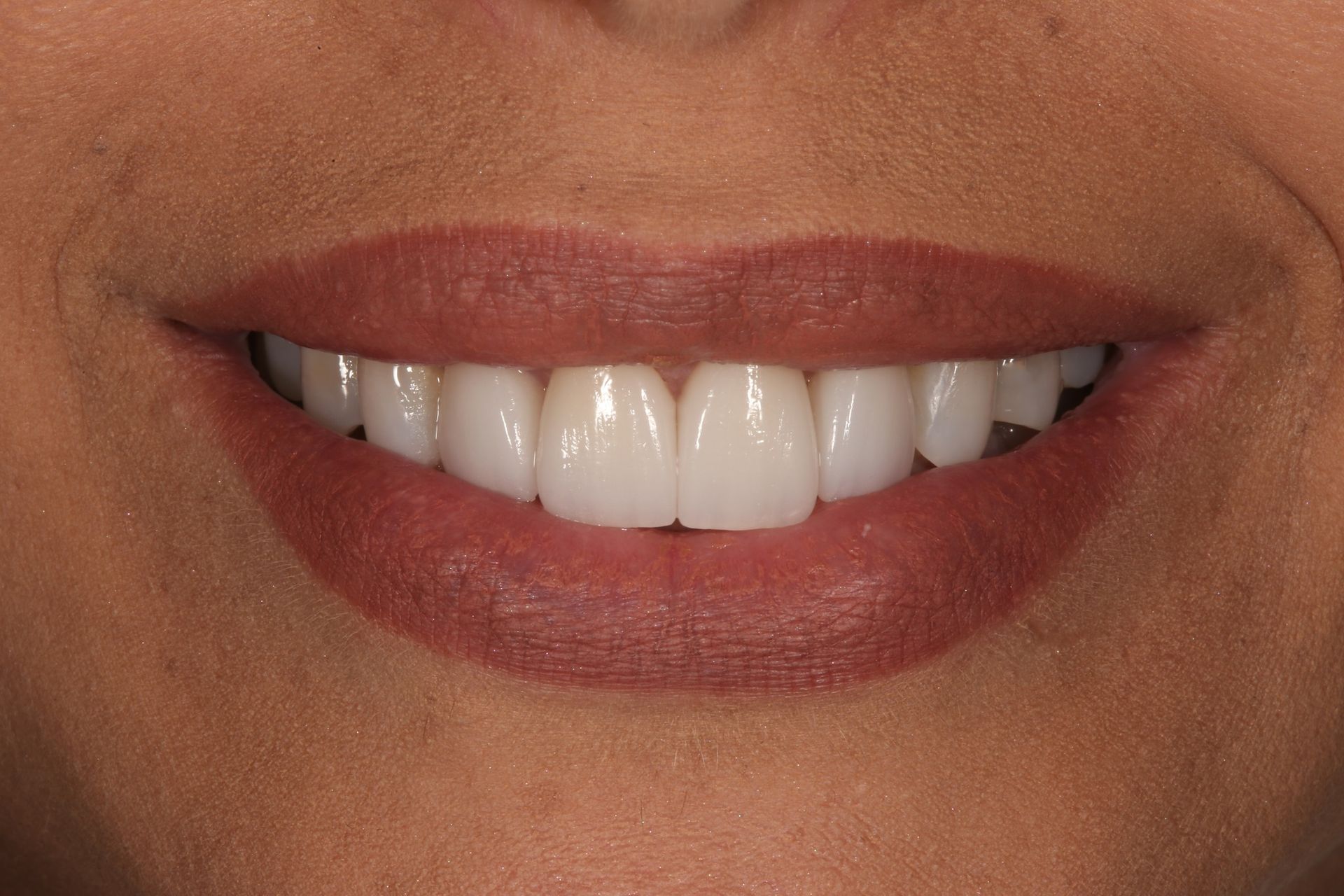A close-up of a person's smiling mouth, showing bright white, even teeth.