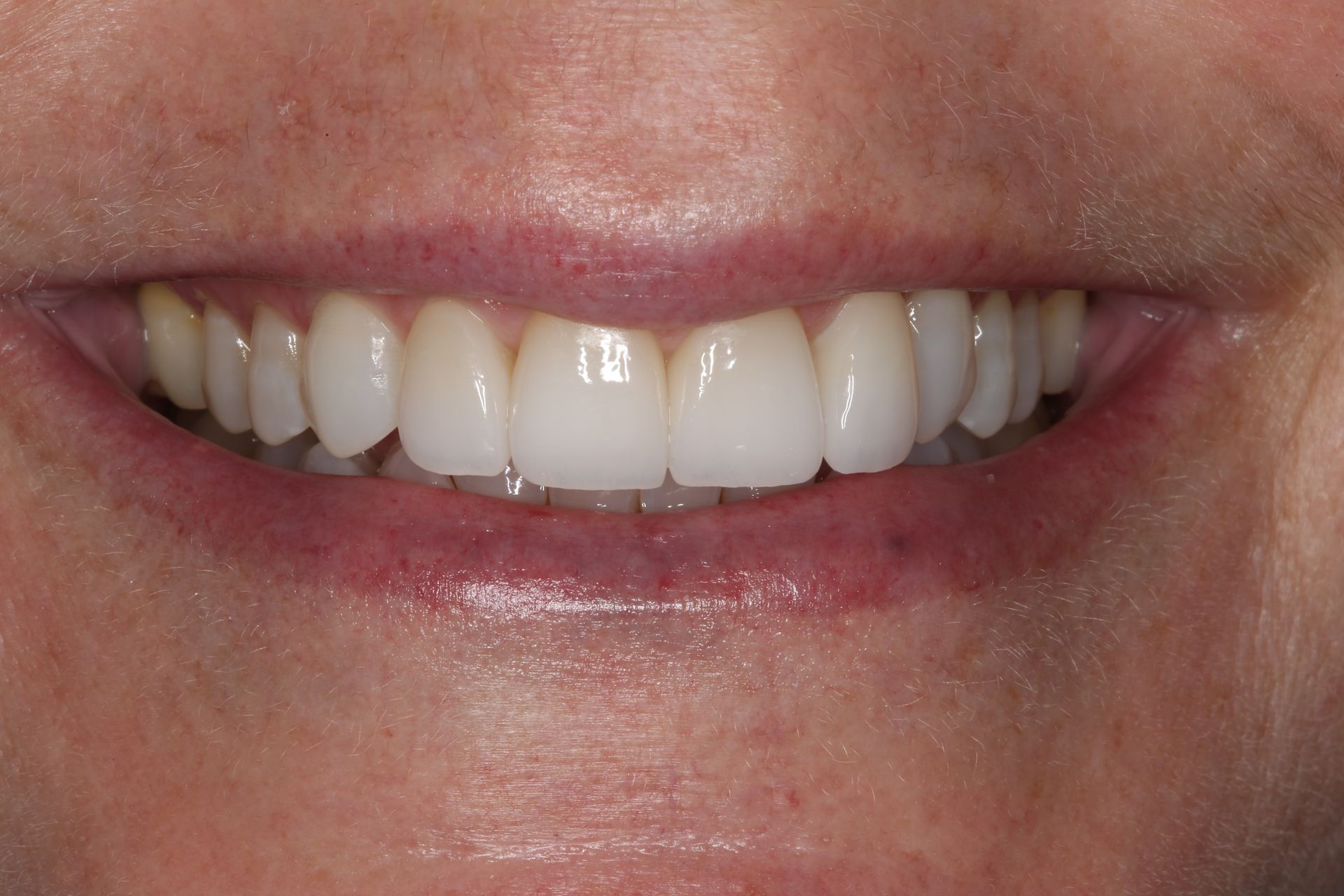 Close-up of a person smiling, revealing a full set of bright, white, straight teeth.