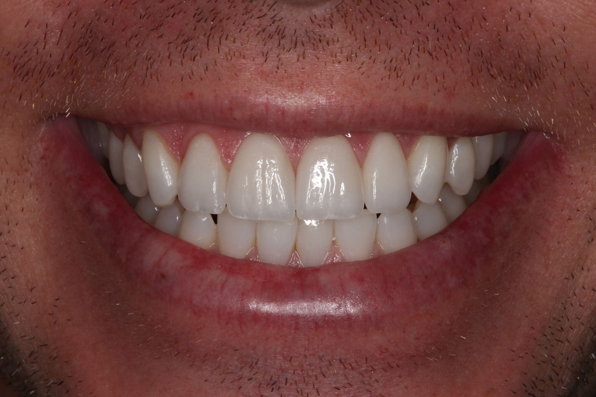 A close-up view of a smiling mouth showing straight, bright white teeth.