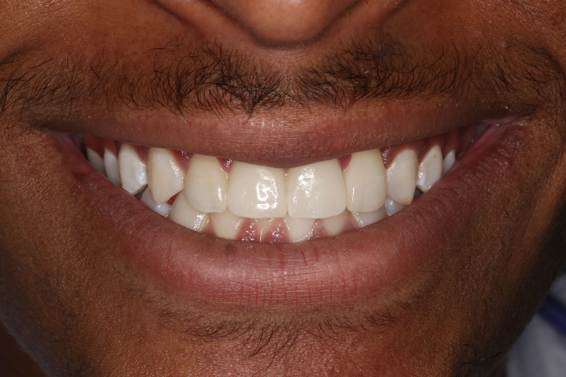 Close-up of a person smiling, showing straight, white teeth and healthy gums.
