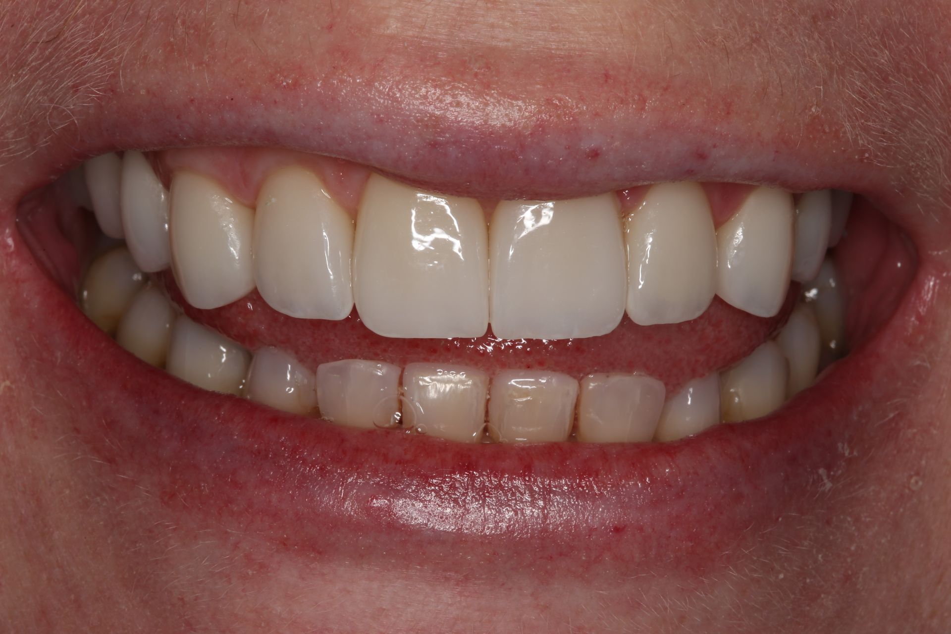 A close-up view of a person smiling, showcasing a set of clean, white, and well-aligned teeth.