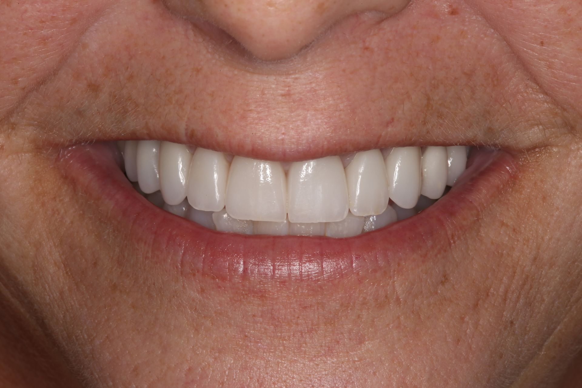 A close-up of a person's mouth displaying a set of bright, white, straight teeth while smiling.