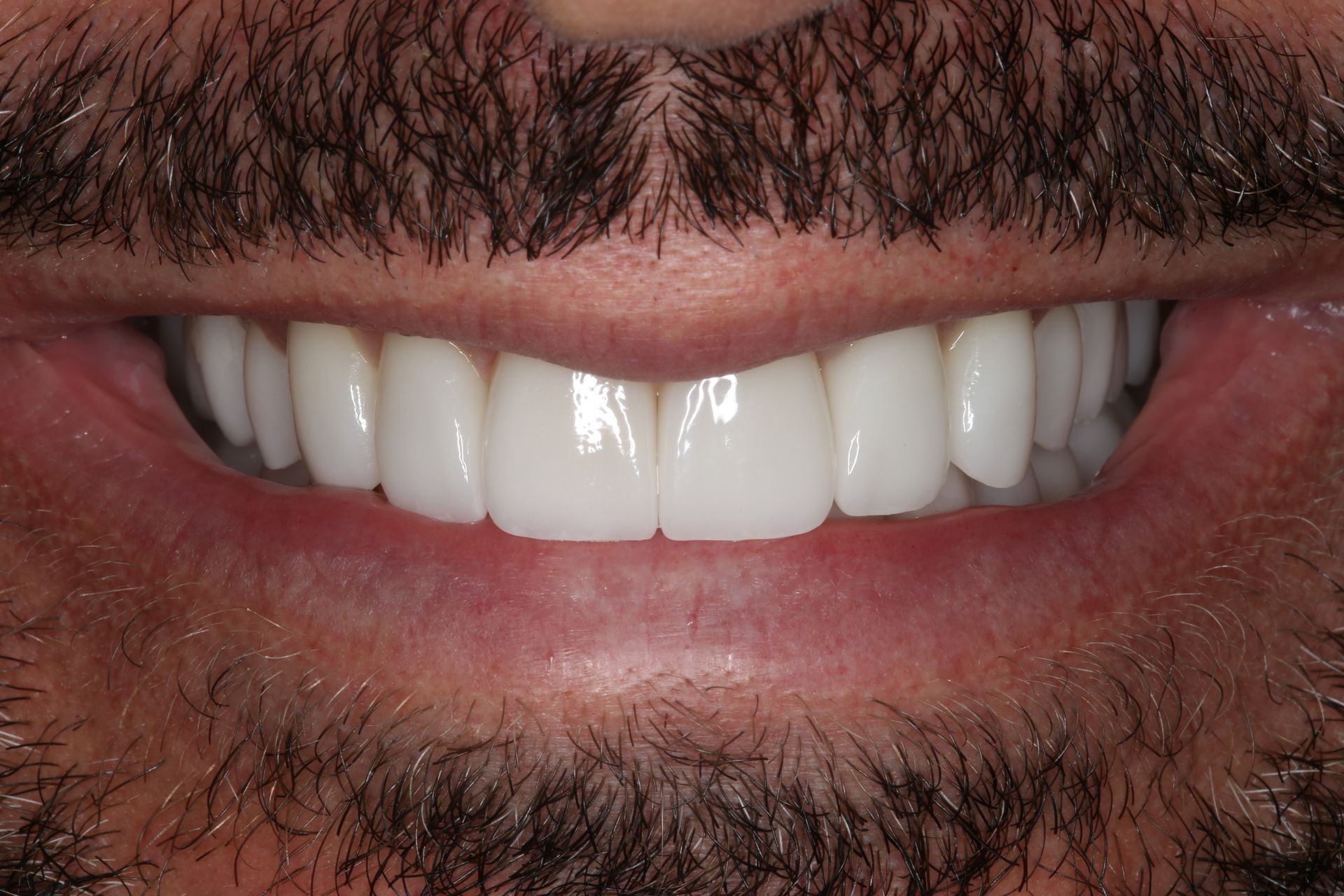 A close-up view of a person’s lower face, showing straight, white, healthy teeth in a neutral, relaxed expression.
