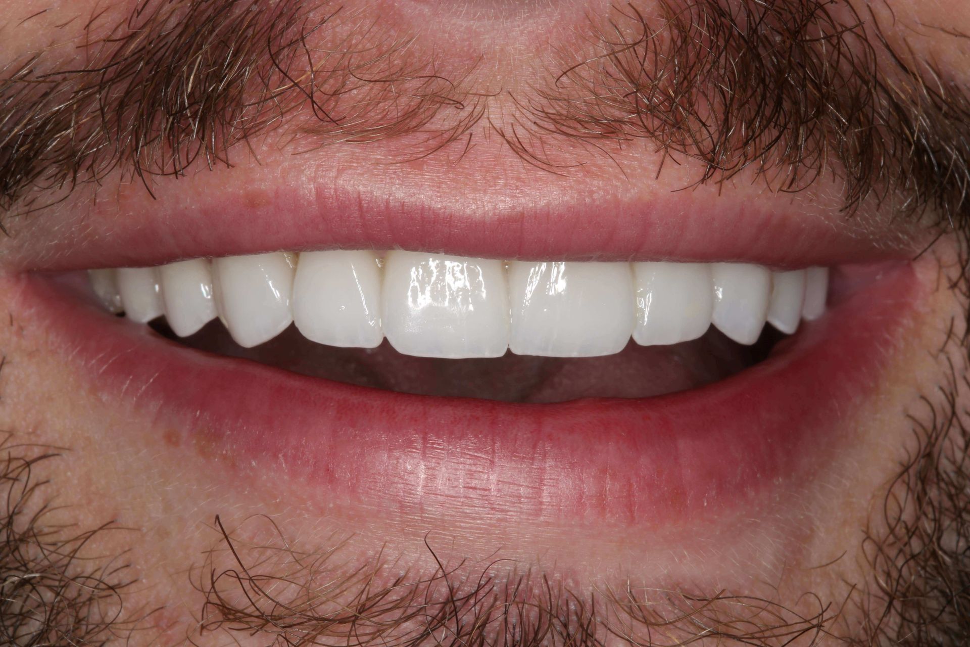 A close-up of a person smiling, showing a full set of bright white, aligned teeth.