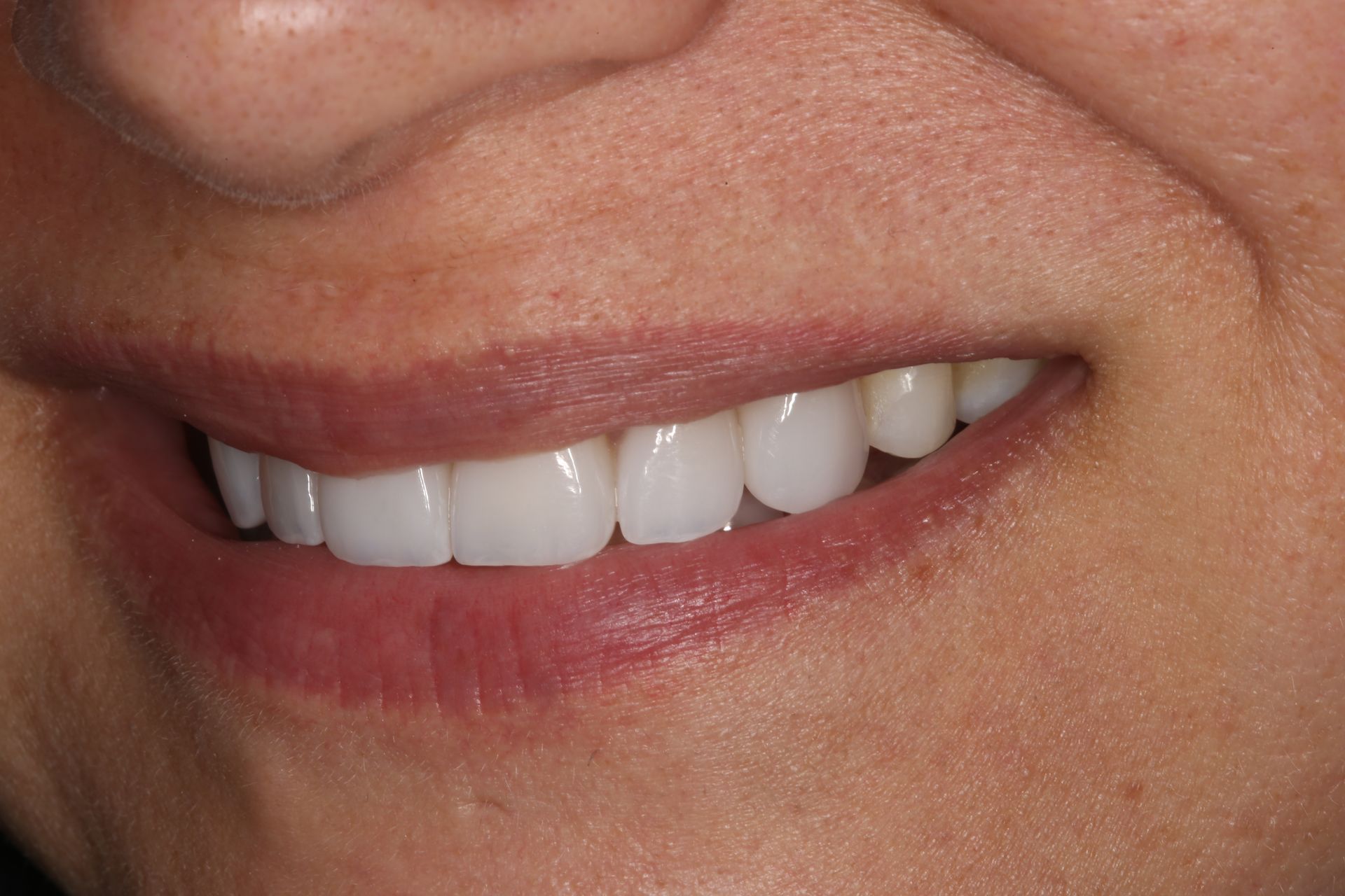 A close-up view of a person’s mouth showing straight, bright white teeth while smiling.