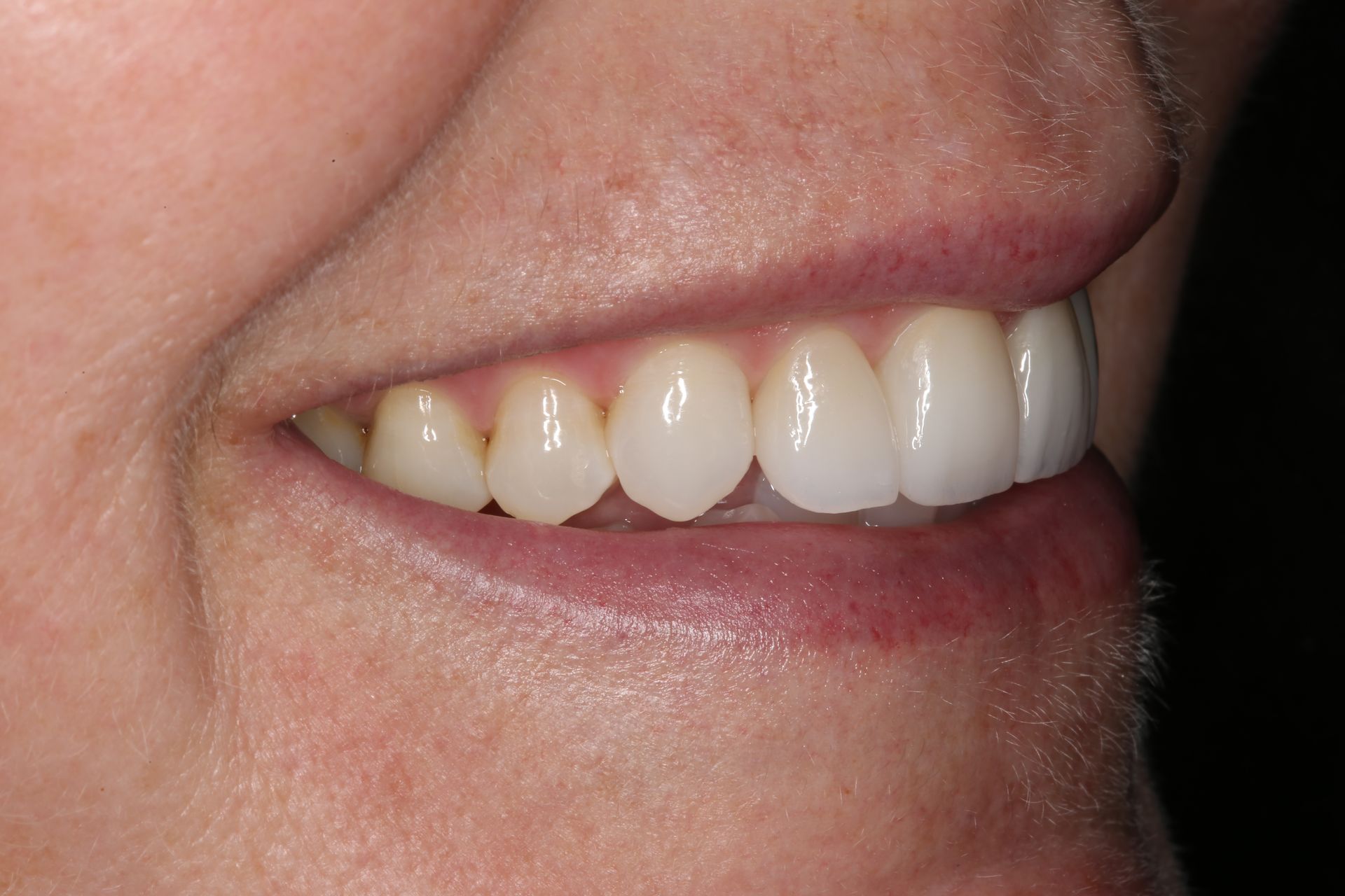 A close-up profile view of a person smiling, showcasing well-aligned, natural-looking teeth.