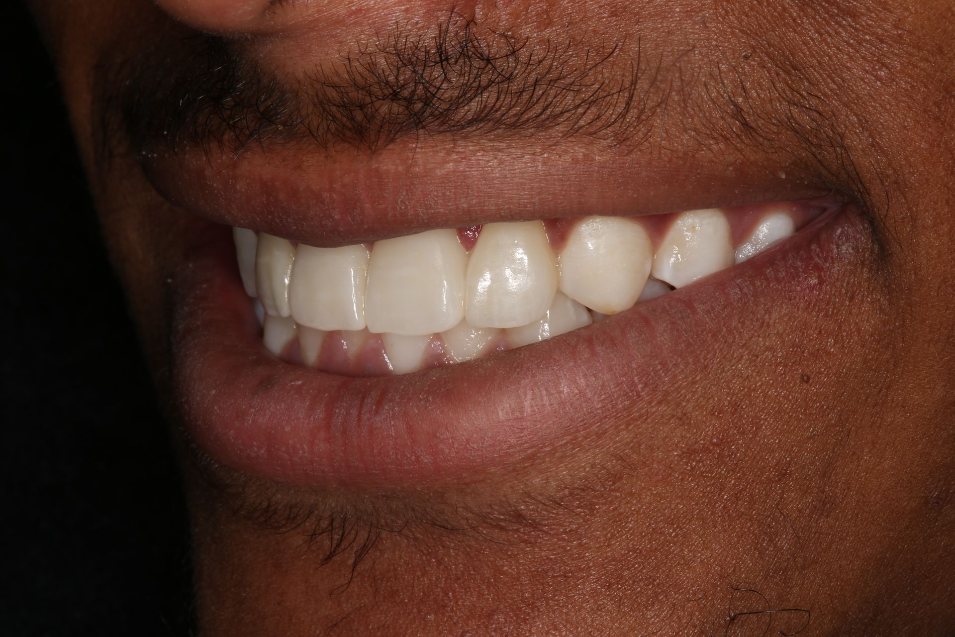 A close-up of a person smiling, showcasing a set of well-aligned, natural-looking white teeth.