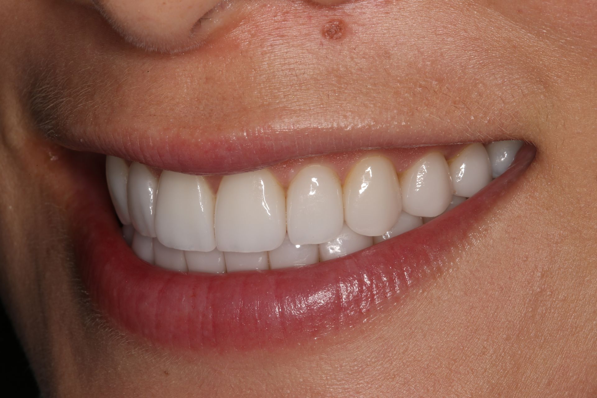 A close-up view of a smiling mouth showing straight, bright white teeth.