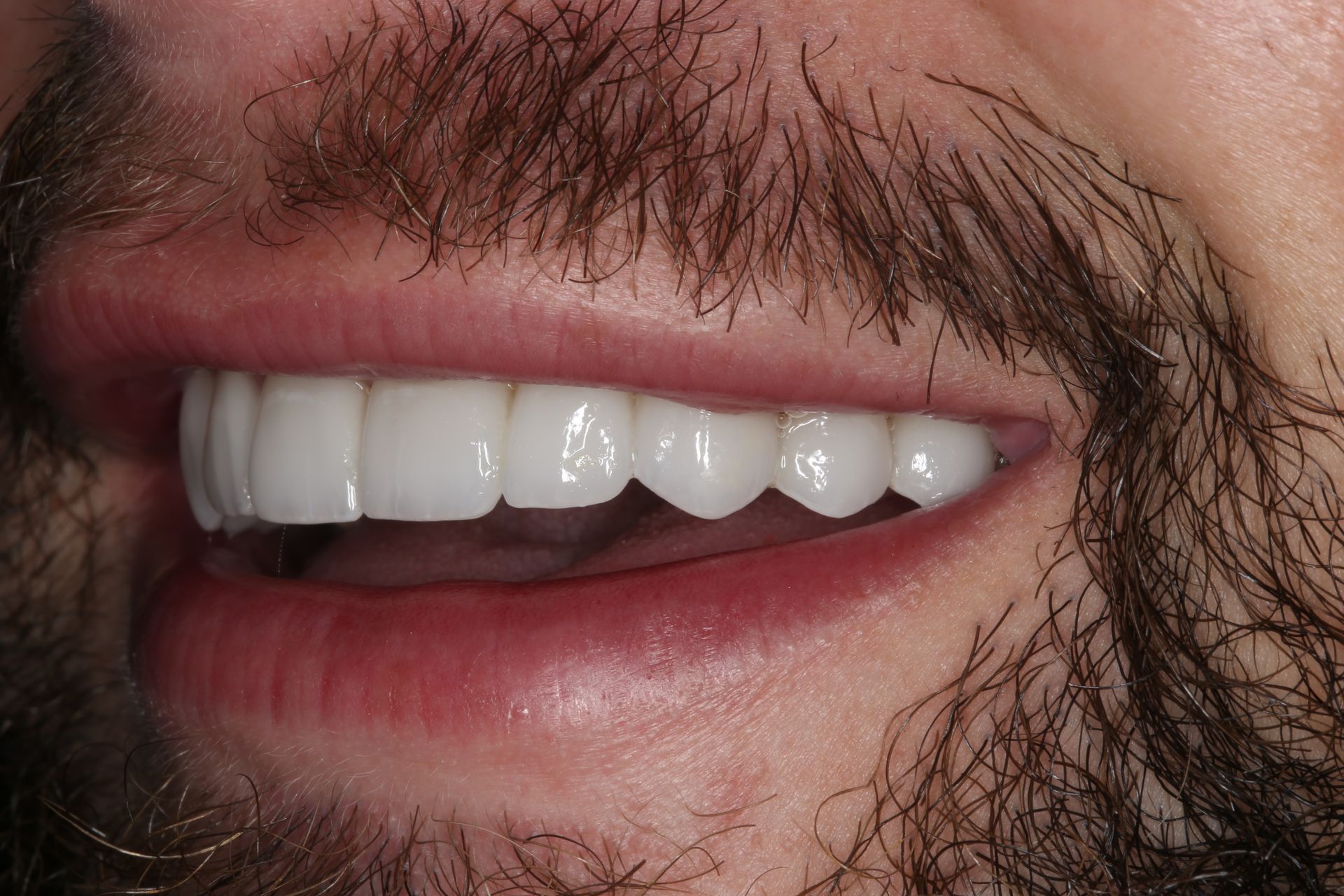 A close-up view of a smiling mouth showing a set of white, well-aligned teeth and a groomed mustache.