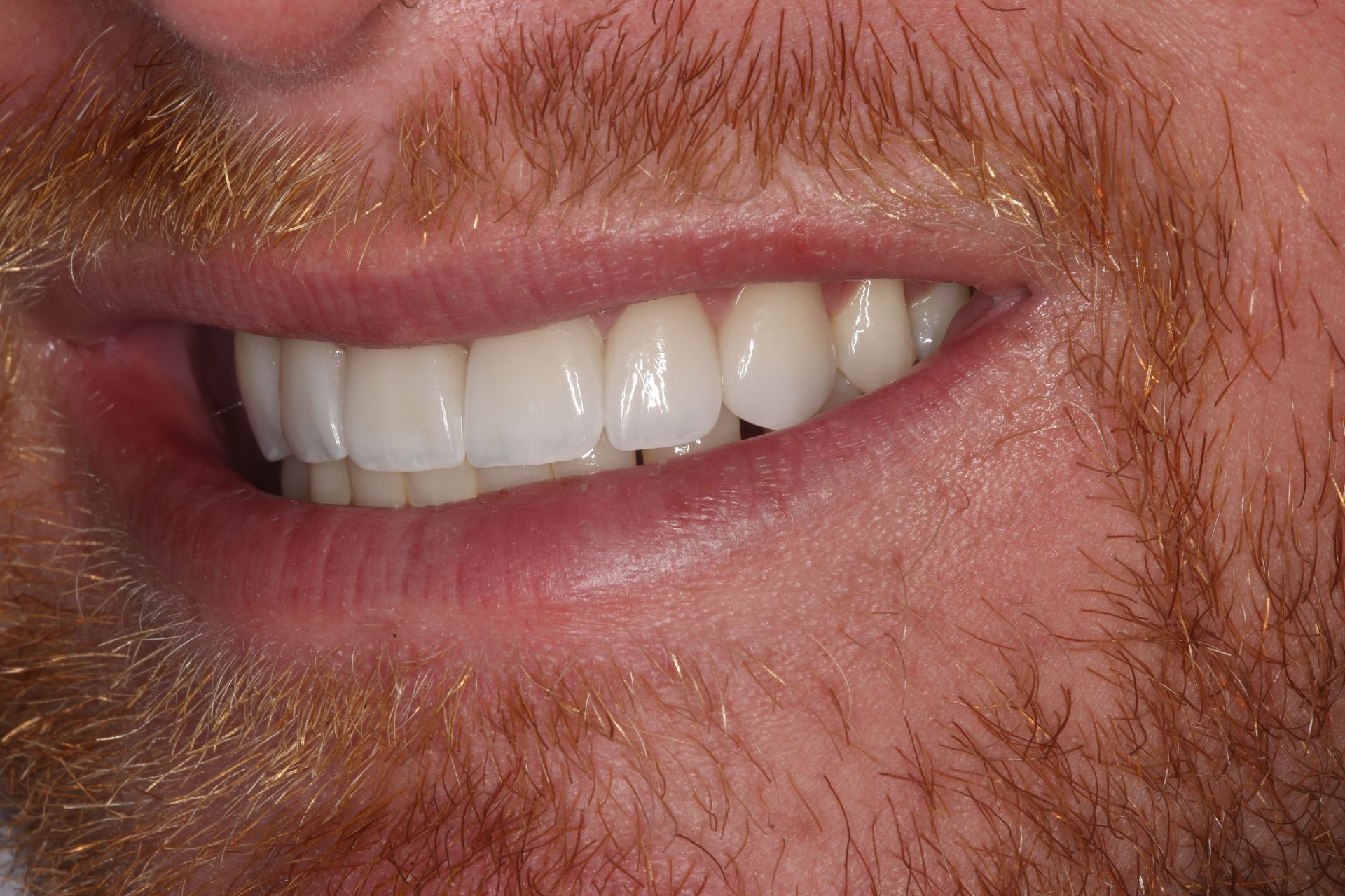 Close-up of a person with a red beard smiling to show clean, white, straight teeth.