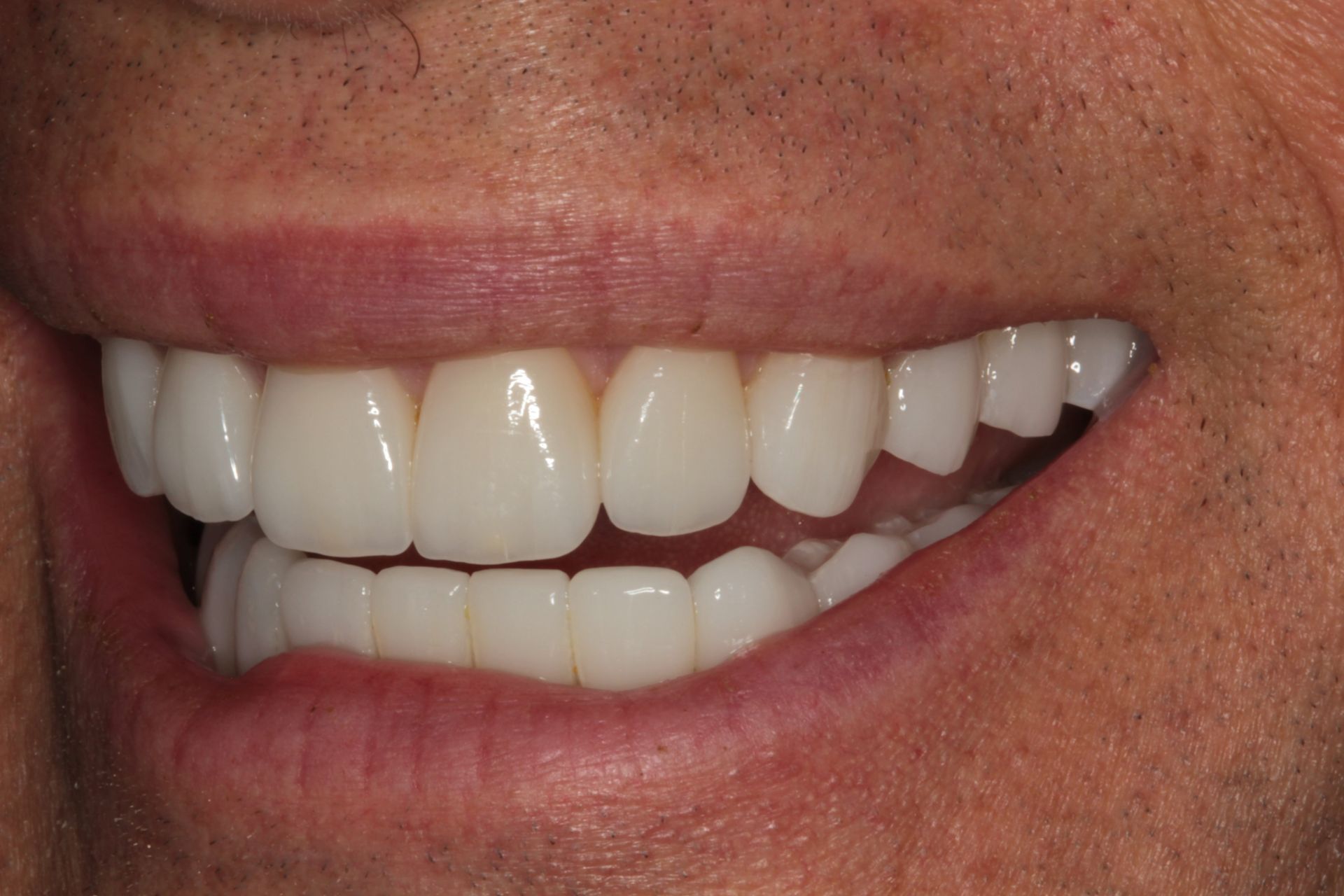 Close-up of a person smiling, showing straight, white dental crowns on both upper and lower teeth.