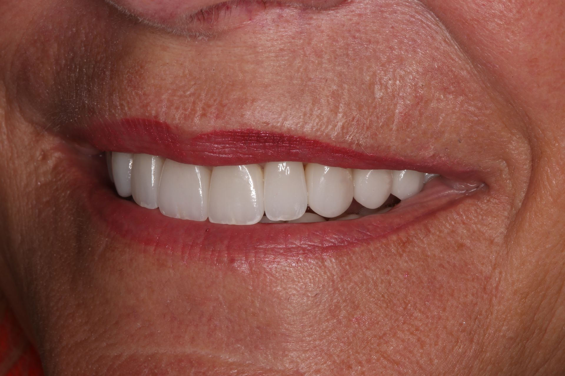 Close-up of a person showing an even row of white, natural-looking dental veneers or restorations.