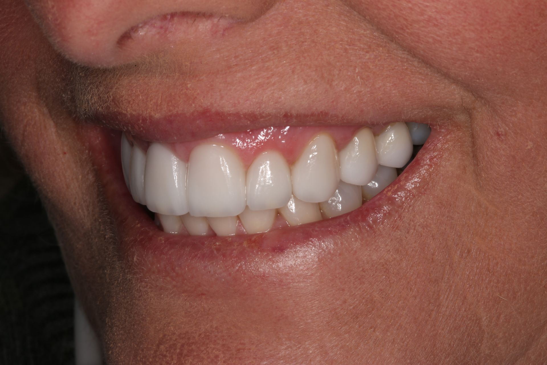 A close-up of a person's smile, showing a set of white, well-aligned teeth and natural-looking gums.