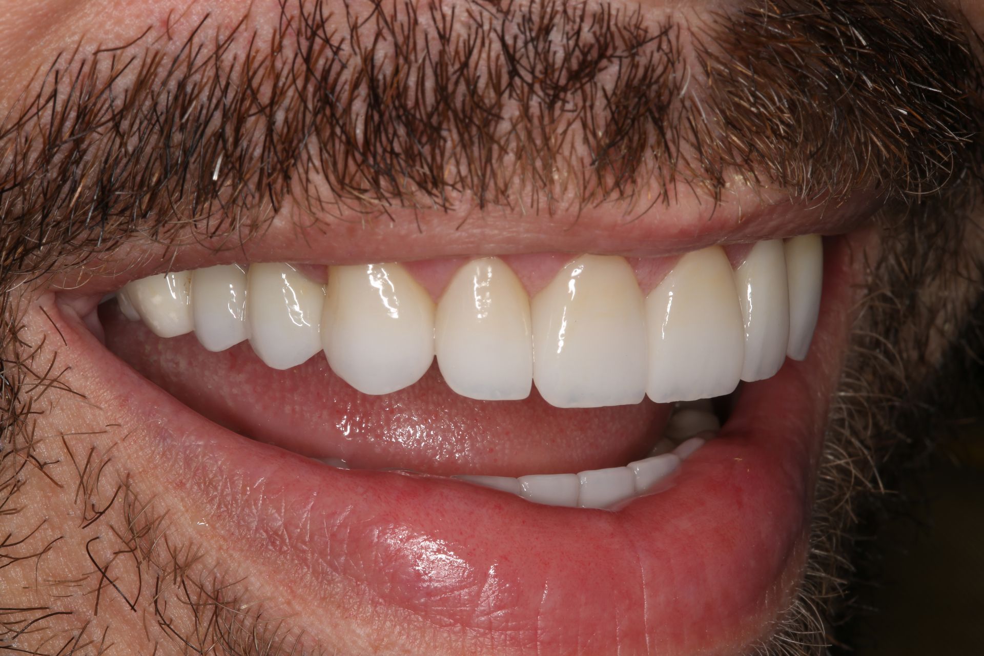 A close-up of a person smiling, showcasing straight, white teeth with a natural, healthy appearance.