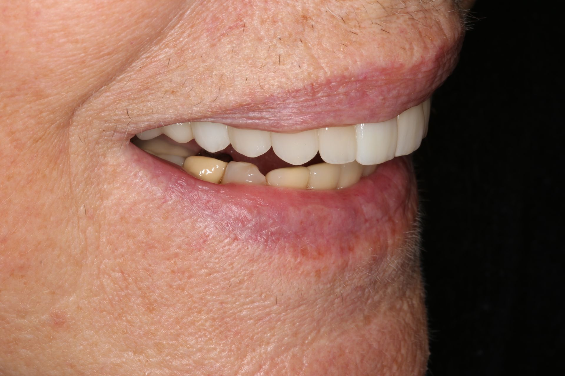 A side profile view of a person’s lower face showing bright, white upper teeth and slightly yellowed lower teeth.