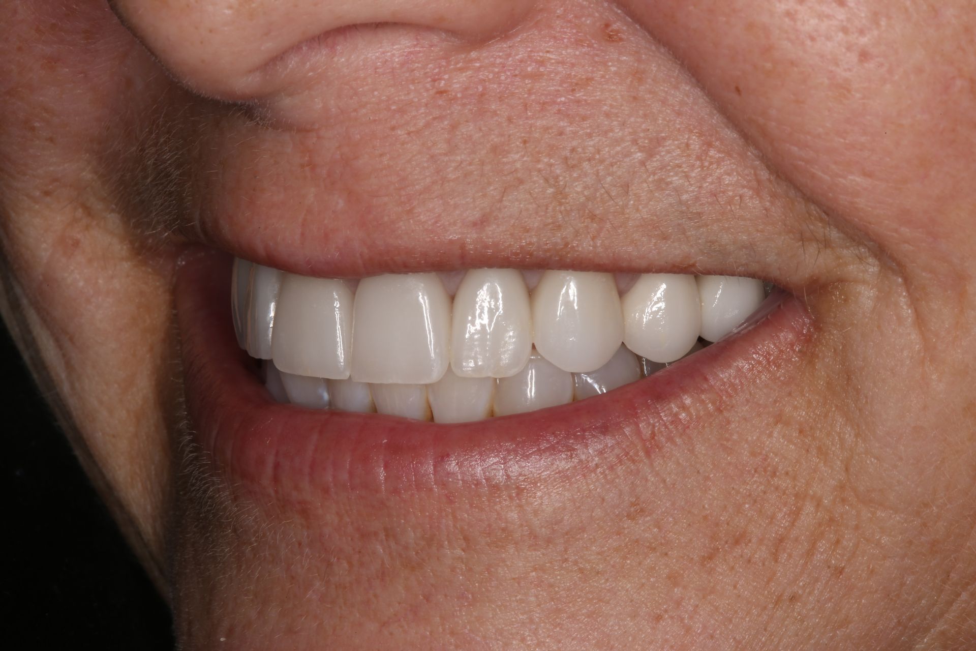A close-up of a person's mouth showing a row of white, straight teeth in a gentle smile.