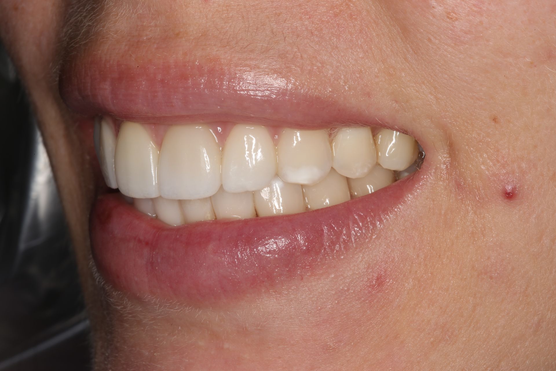 A close-up profile view of a person smiling, showcasing straight, white teeth and gums.