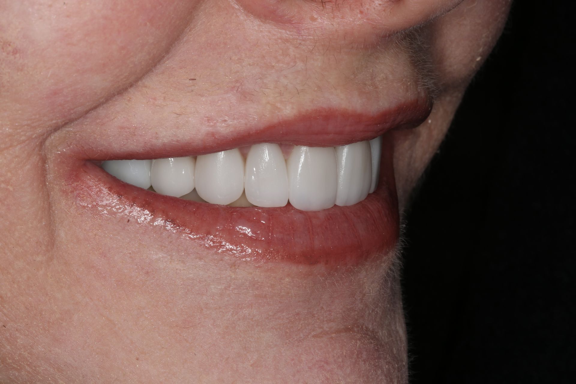 A close-up profile view of a person smiling, showcasing a set of white, well-aligned teeth and natural-looking restorations.