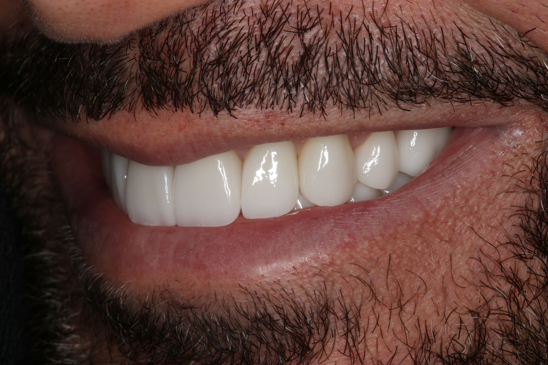 Close-up of a person smiling, showing a full set of well-aligned, bright white teeth.