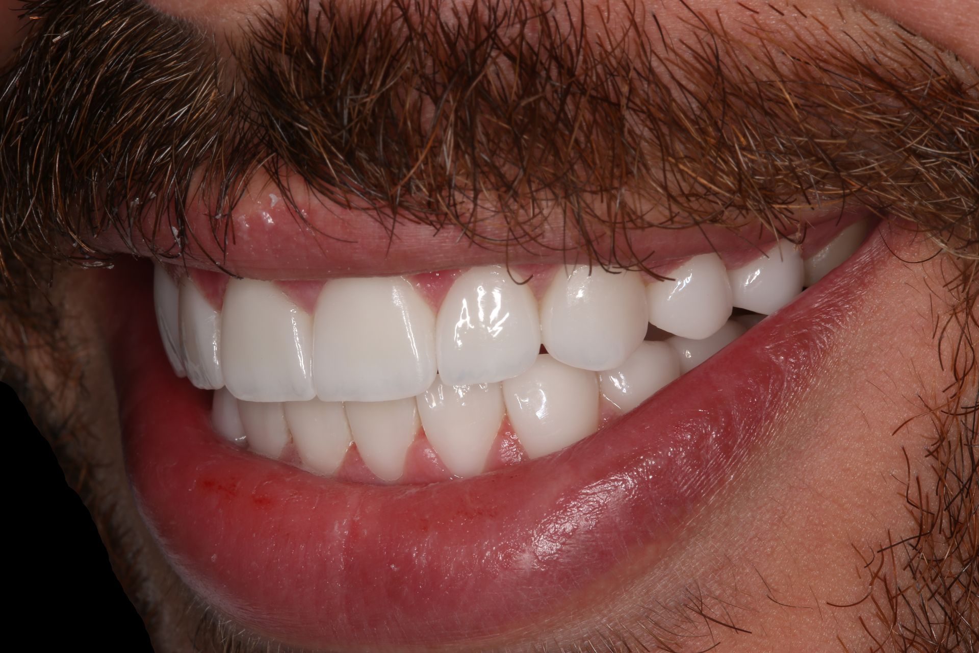Close-up of a person with a mustache smiling to reveal bright white, well-aligned teeth.