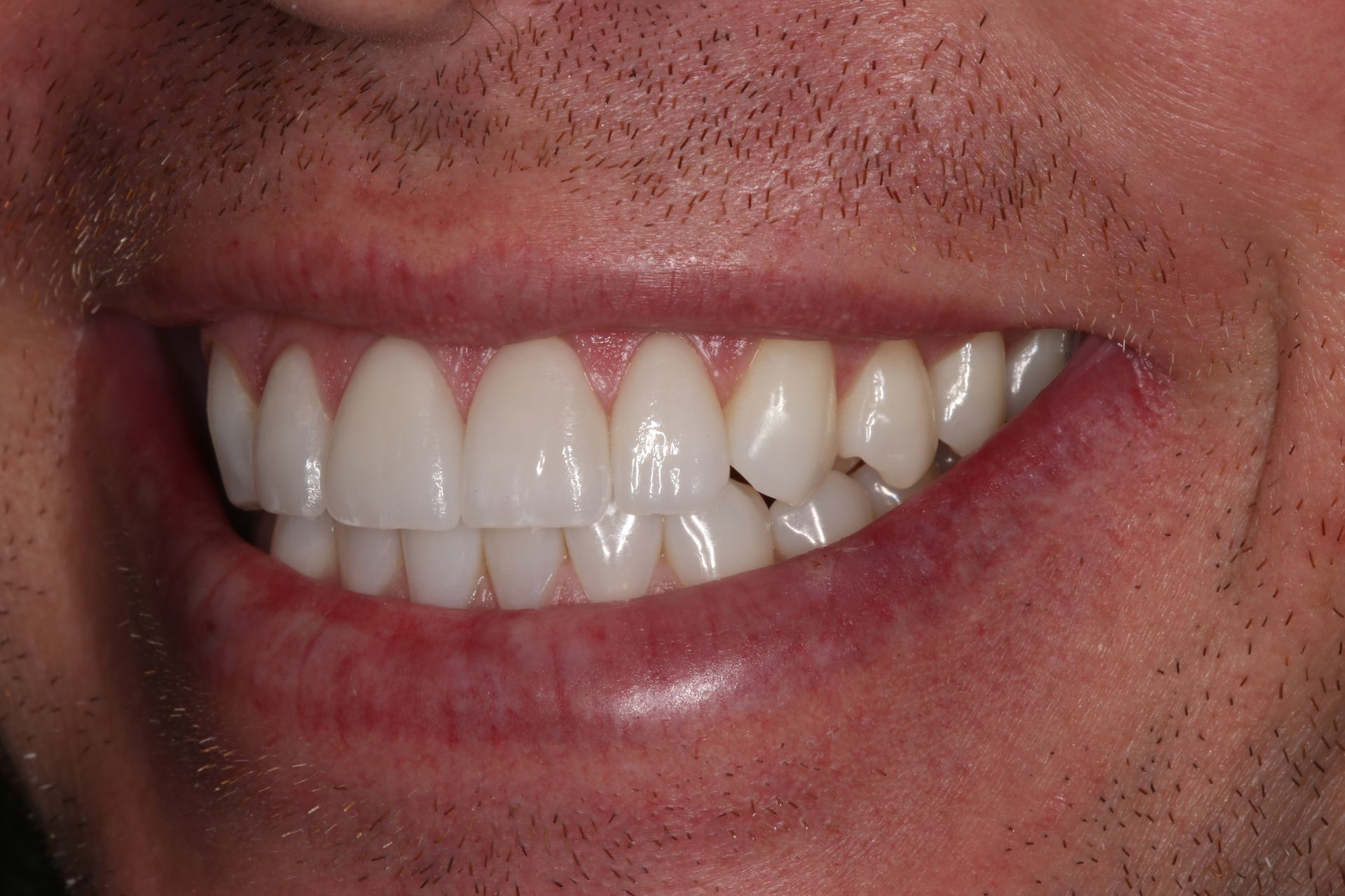 A close-up view of a smiling person showing clean, white, and well-aligned teeth.