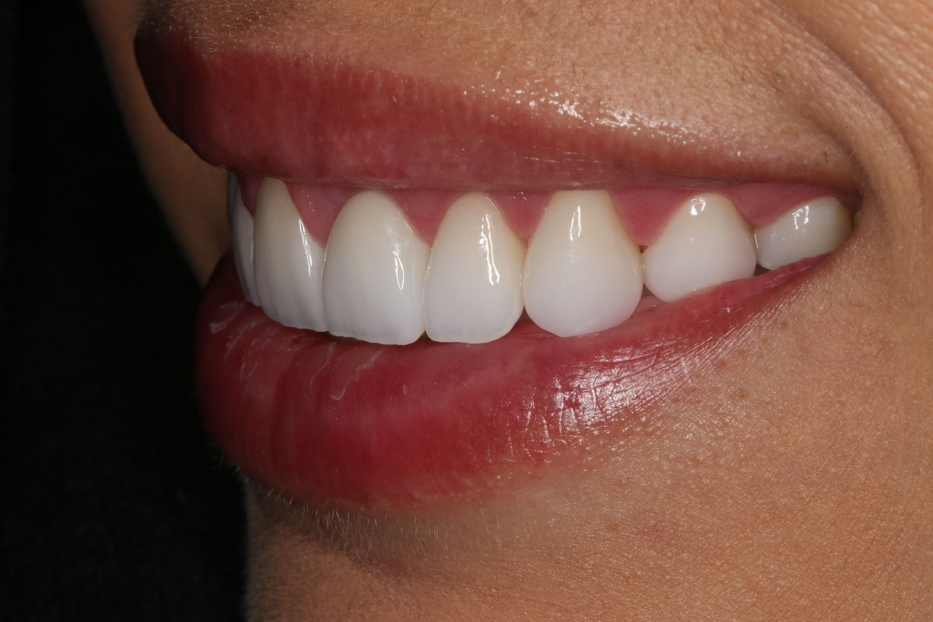 A close-up of a person smiling, showcasing straight, white teeth and pink gums.