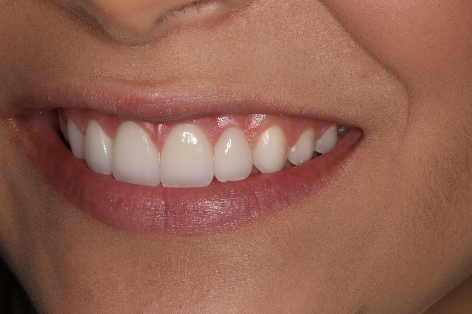 Close-up of a person’s smile showing healthy, white, naturally aligned teeth and pink gums.