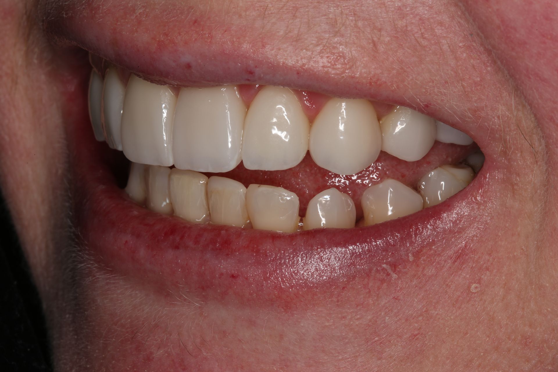A close-up view of a person’s smile, showing upper and lower teeth with a slight overbite.