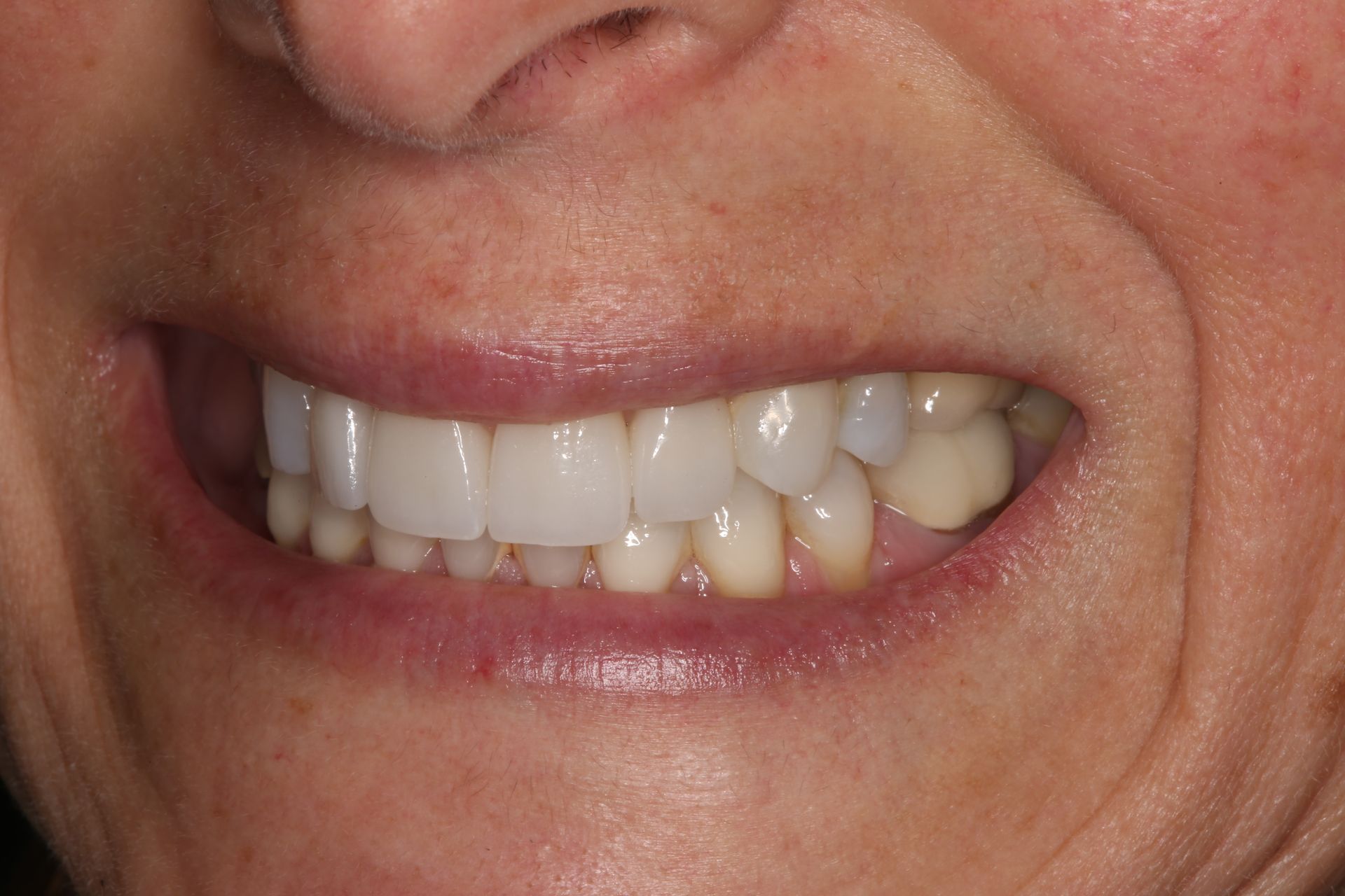 A close-up view of a smiling mouth showing a row of upper and lower teeth, including some visible dental work.