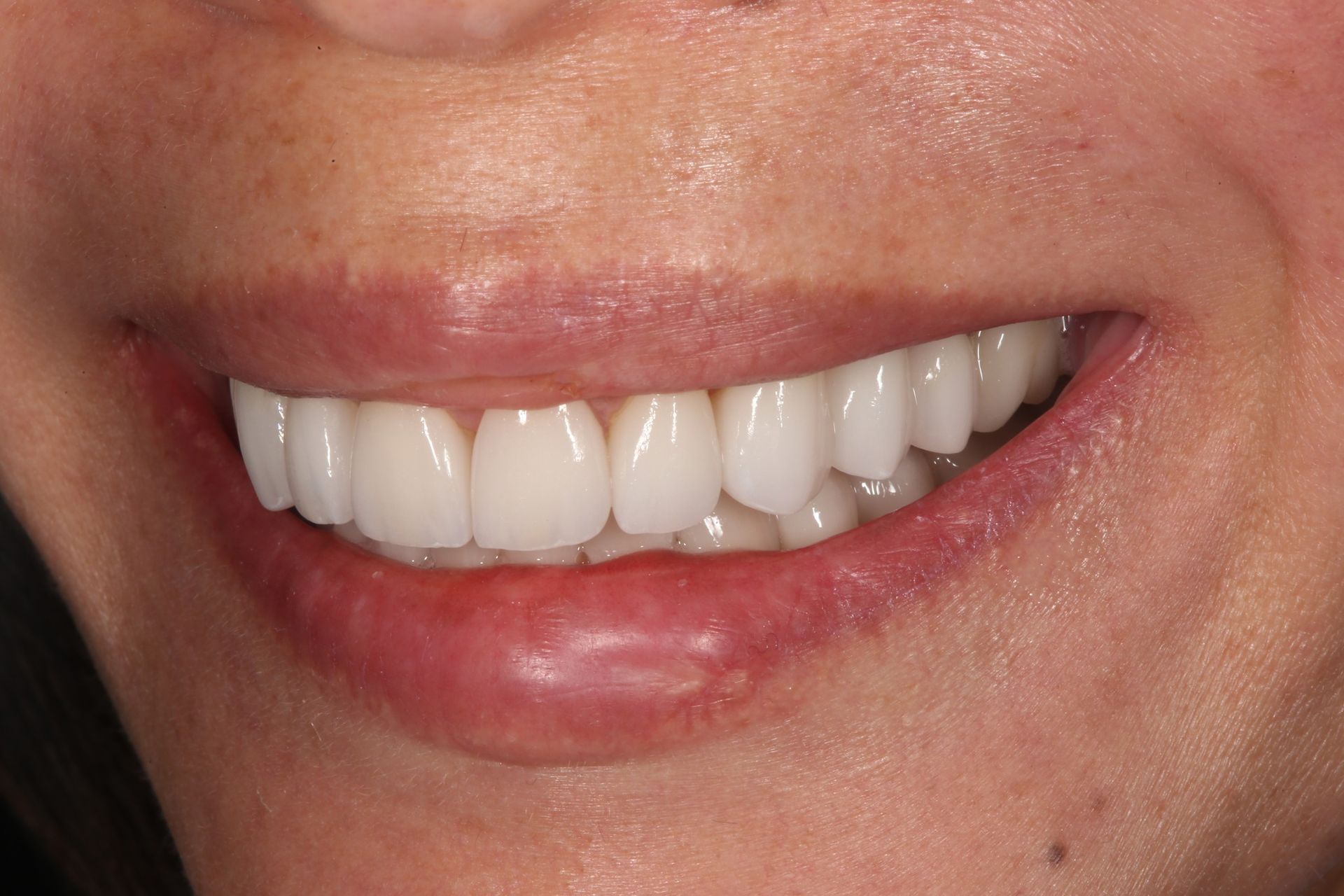 A close-up view of a smiling mouth showcasing bright, white, aligned teeth.