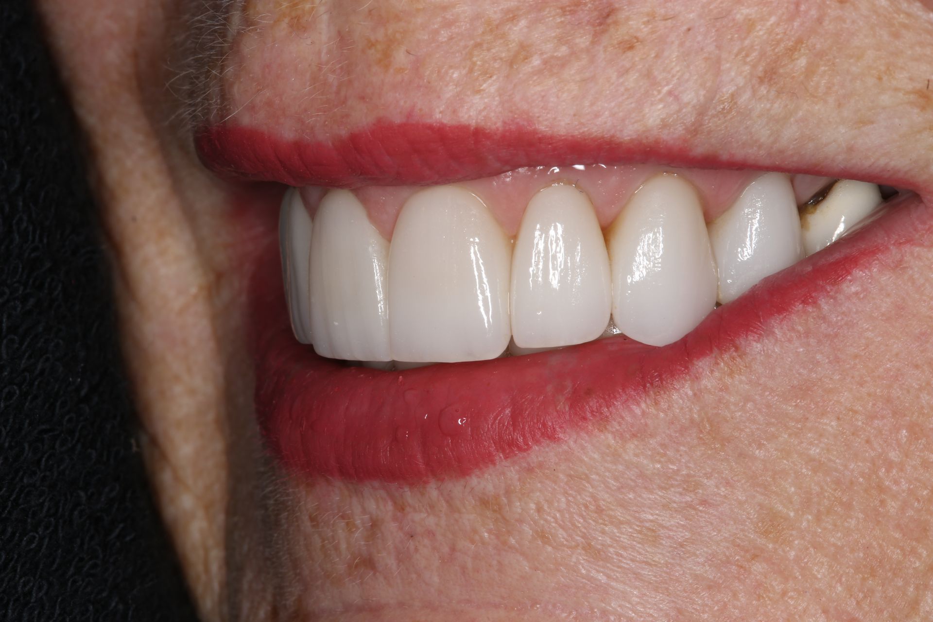 A close-up side view of a person smiling, showcasing a row of straight, white upper teeth.