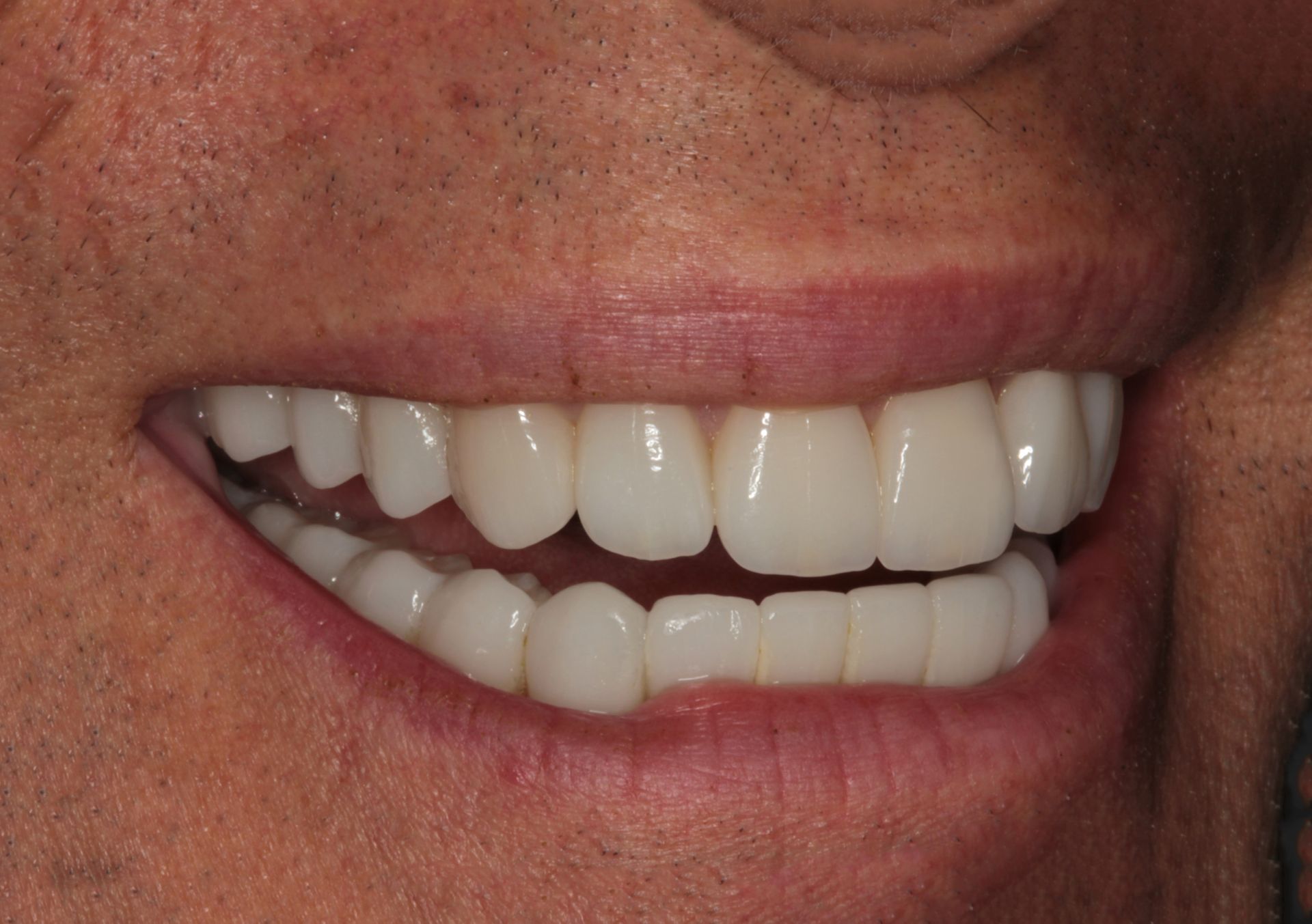 Close-up of a person smiling, showing straight, white dental restorations on the upper and lower teeth.