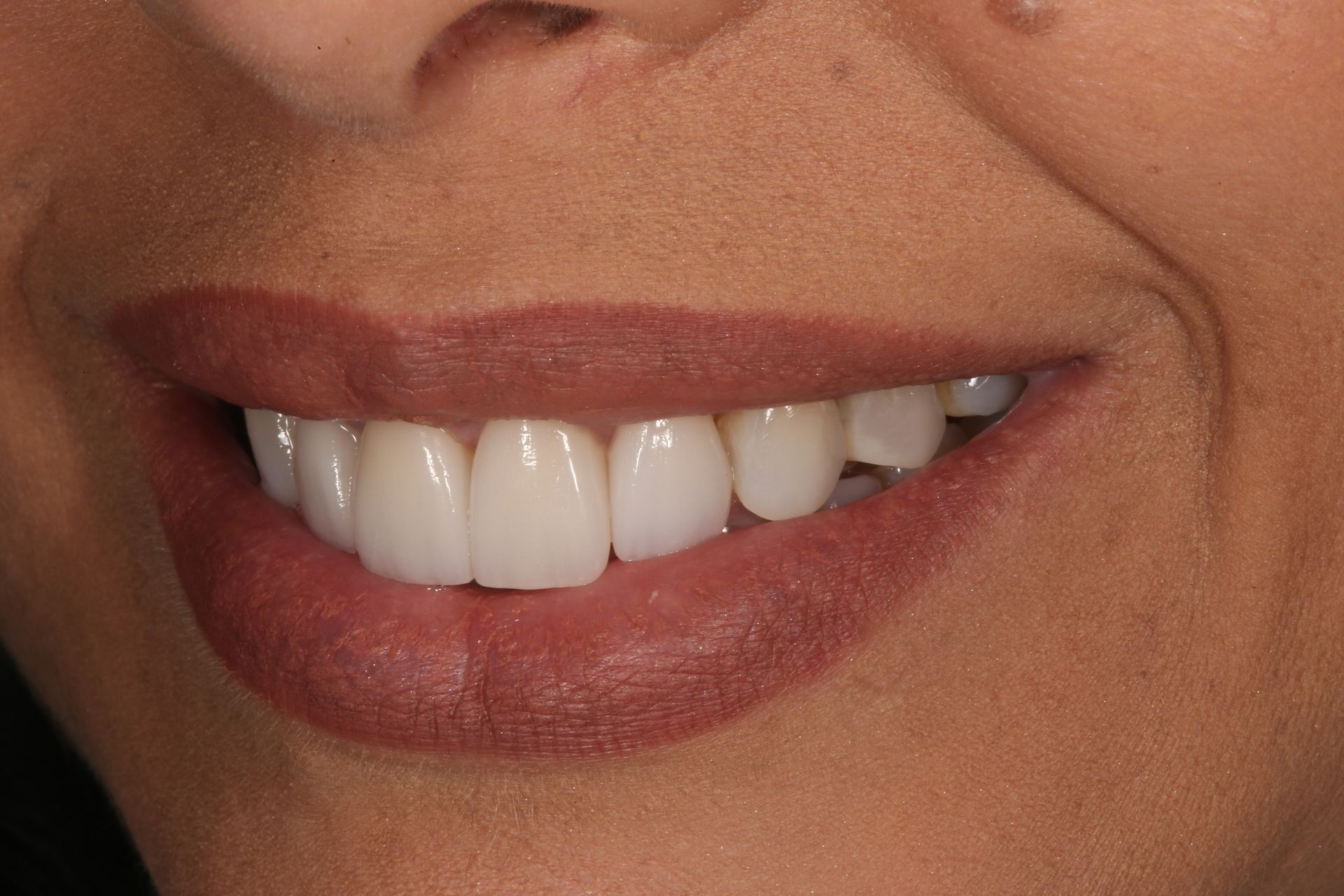 A close-up view of a person’s lower face smiling, showing white, aligned teeth and dark, neutral-toned lipstick.