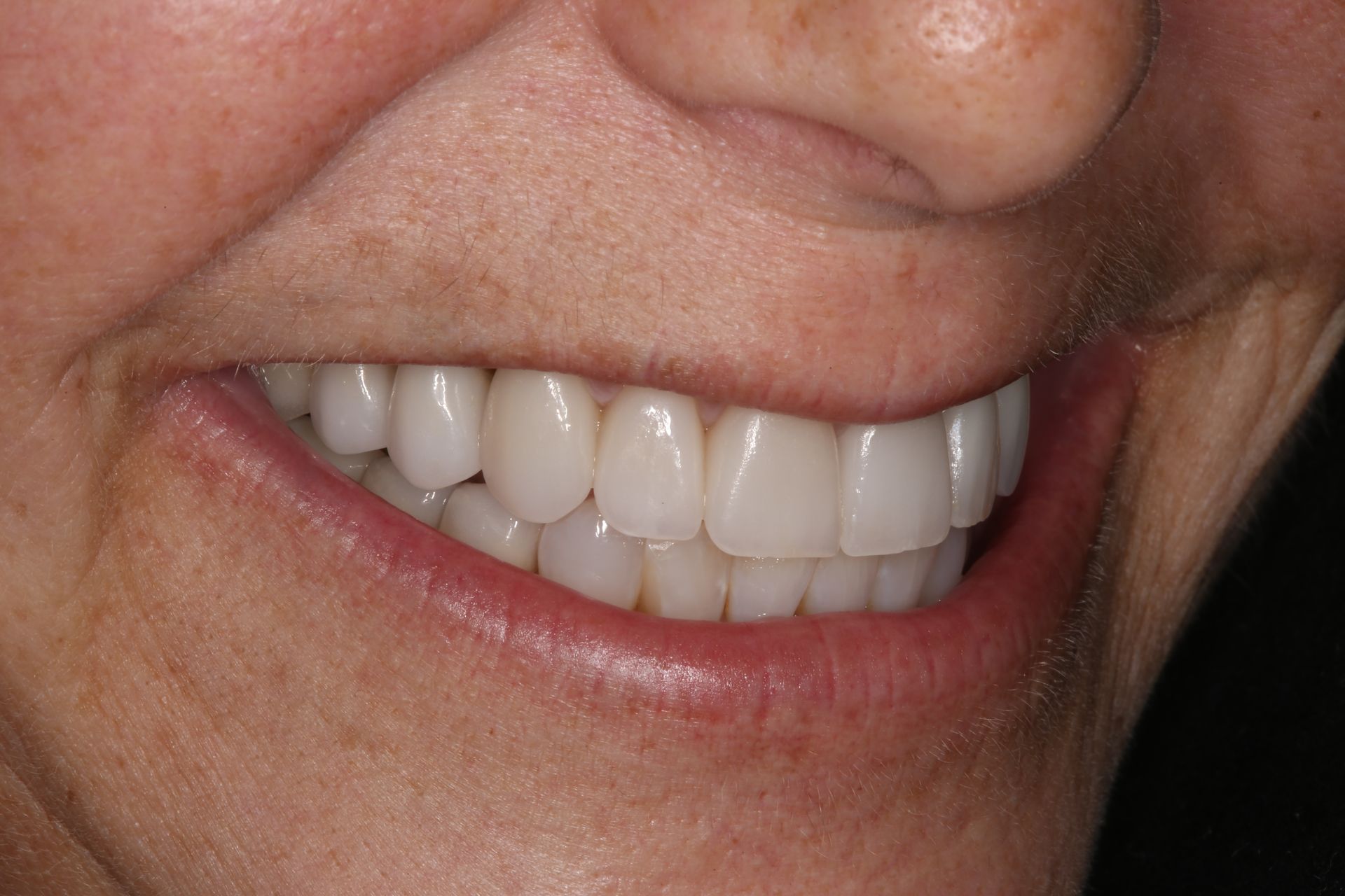 A close-up view of a person smiling, showcasing straight, white teeth.