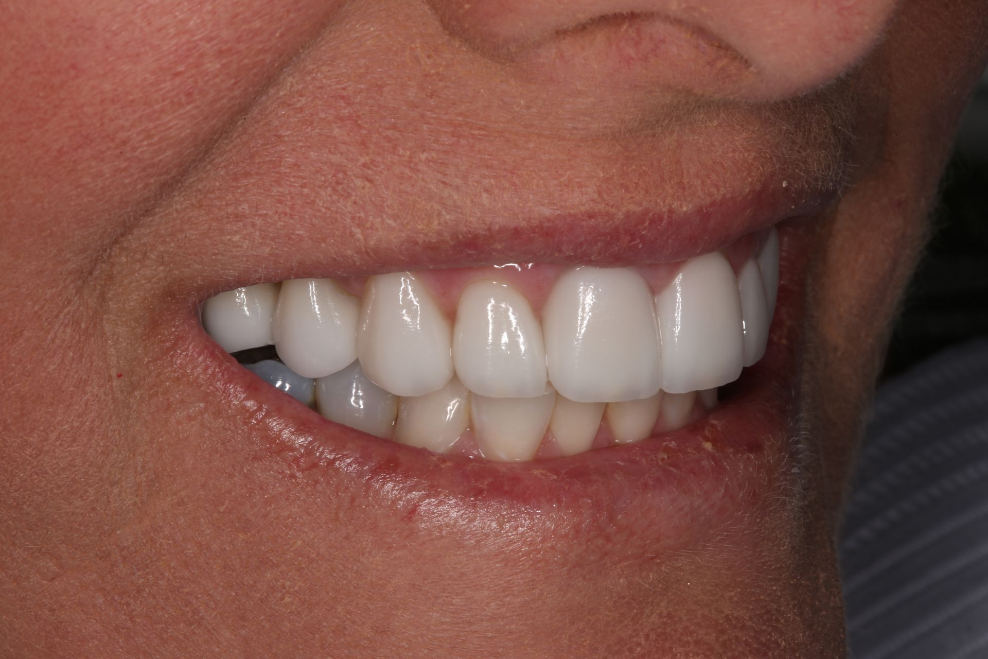 A close-up view of a smiling mouth displaying a set of white, uniform dental restorations.