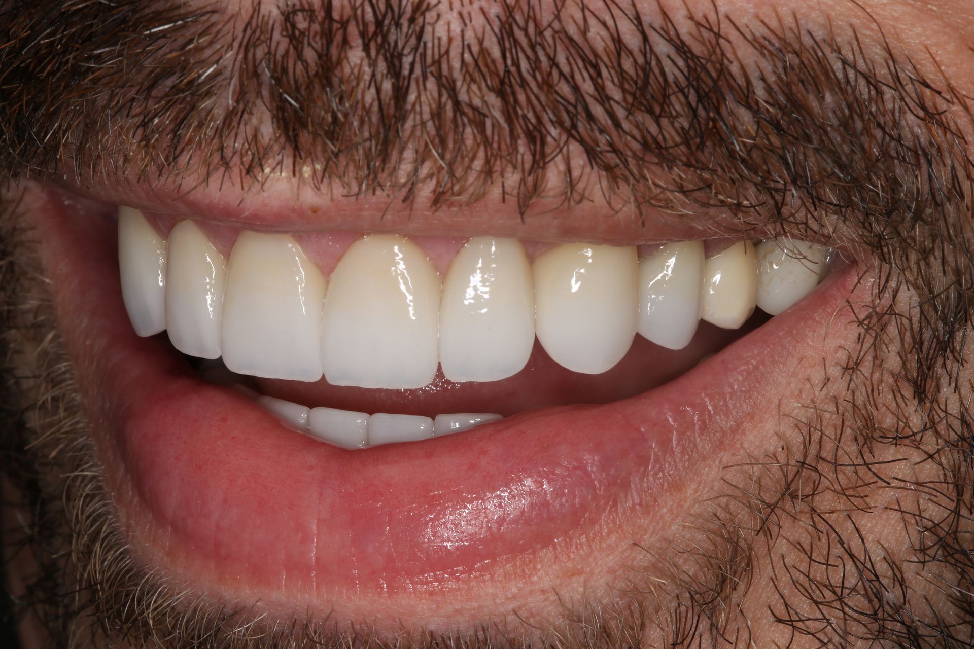 A close-up view of a person’s lower face, showing a bright, white, and aligned smile with well-maintained teeth.