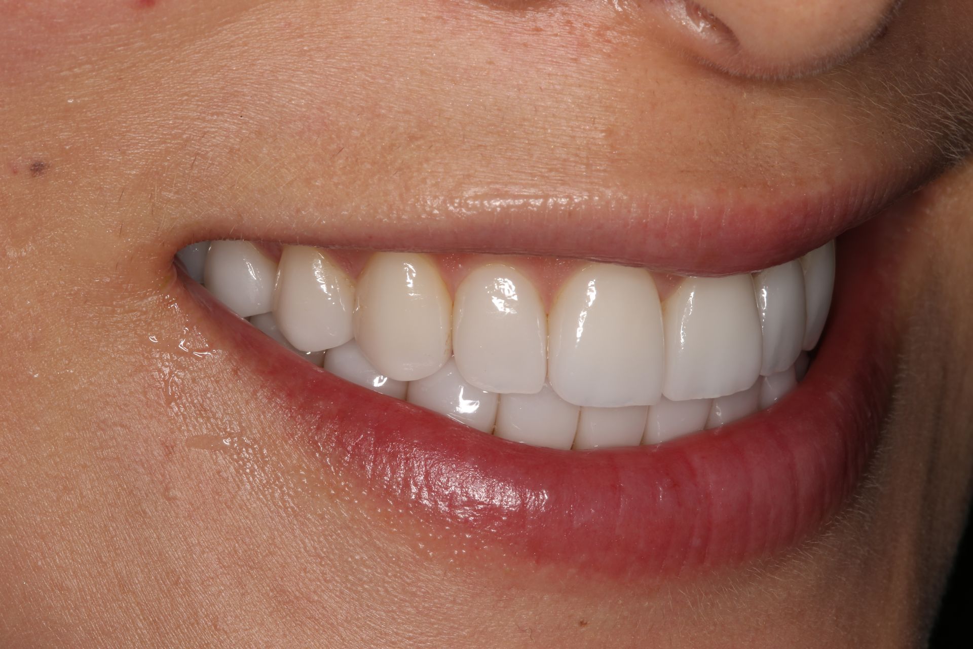 Close-up of a person’s lower face showing an even, white smile with well-aligned, healthy teeth.