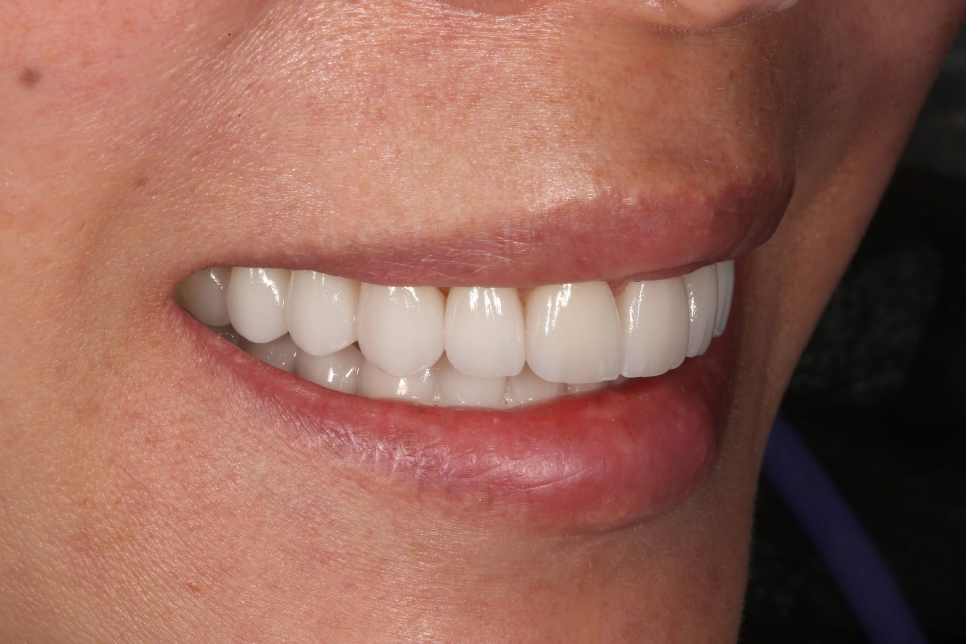 A close-up of a person smiling, showing a full set of bright, white, well-aligned teeth and natural-looking gums.