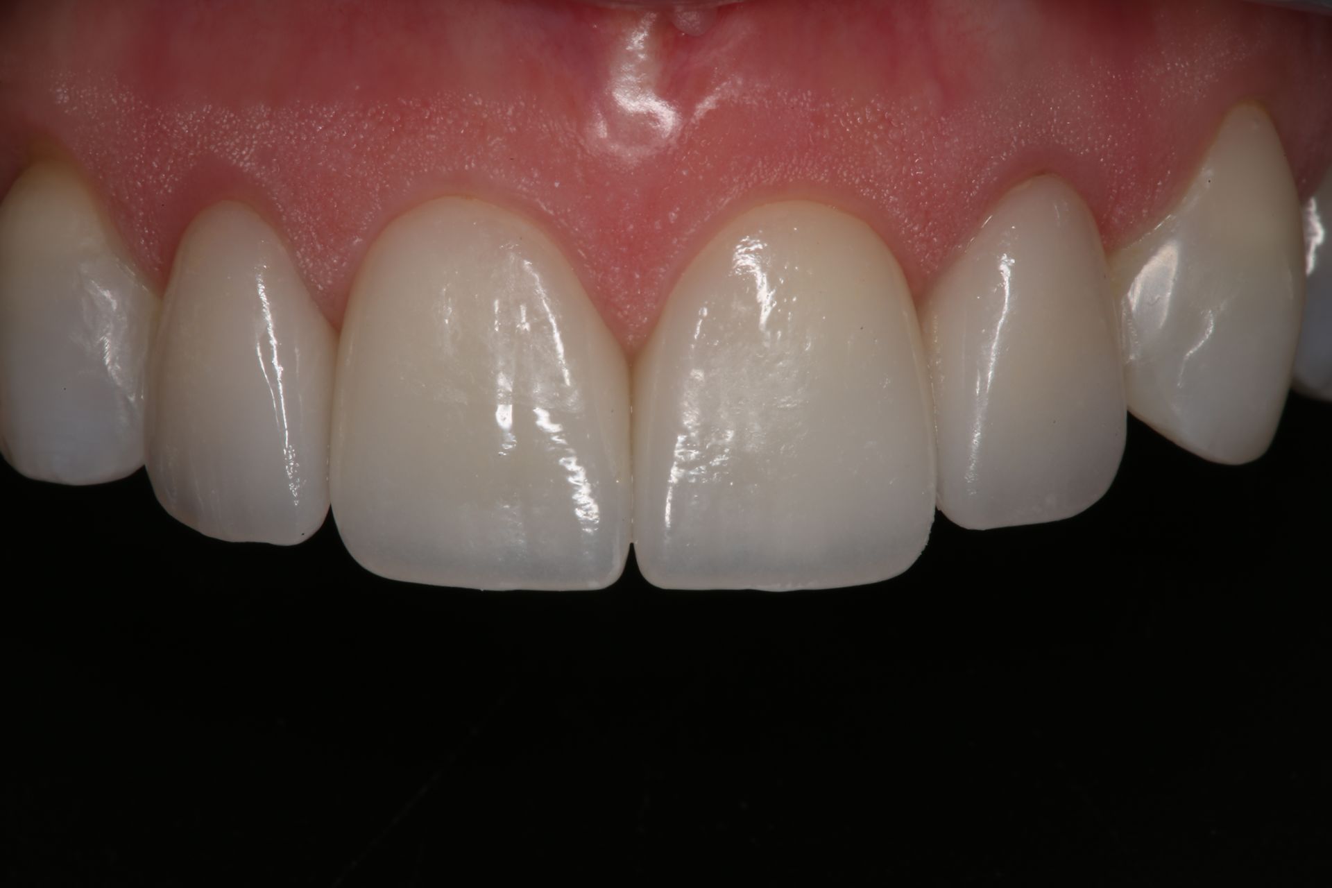 A close-up view of a person's upper front teeth, showing healthy gums and white, well-aligned teeth.