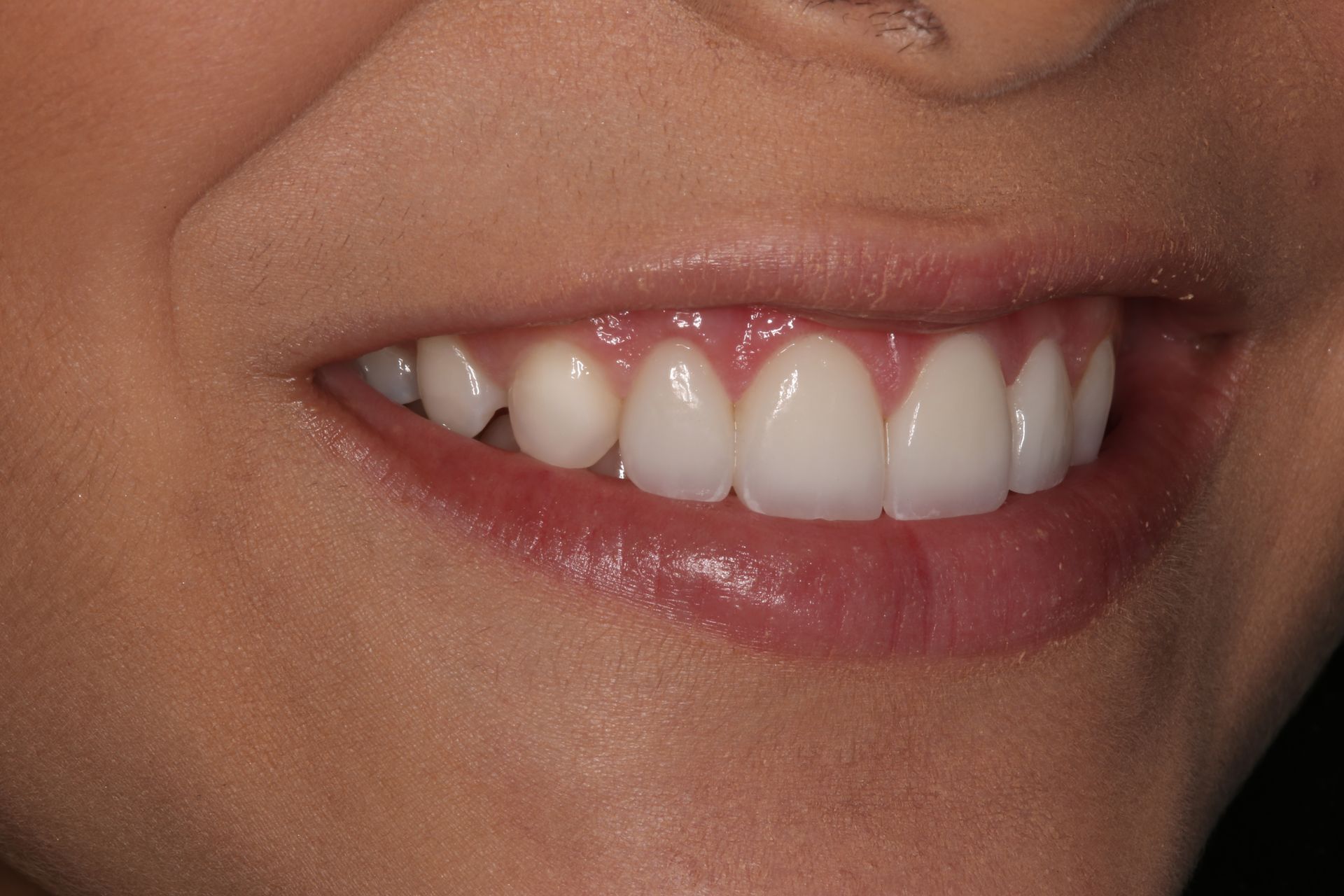 A close-up view of a person’s smile showing healthy, white upper teeth and gums.