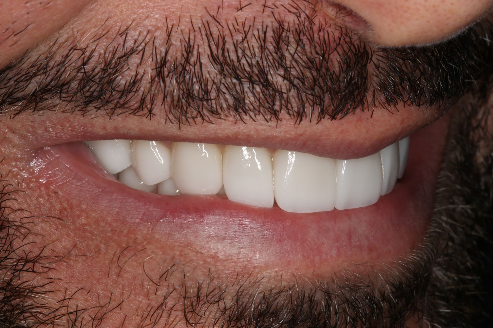 A close-up view of a person’s lower face showing a bright, white smile with straight, restored teeth.