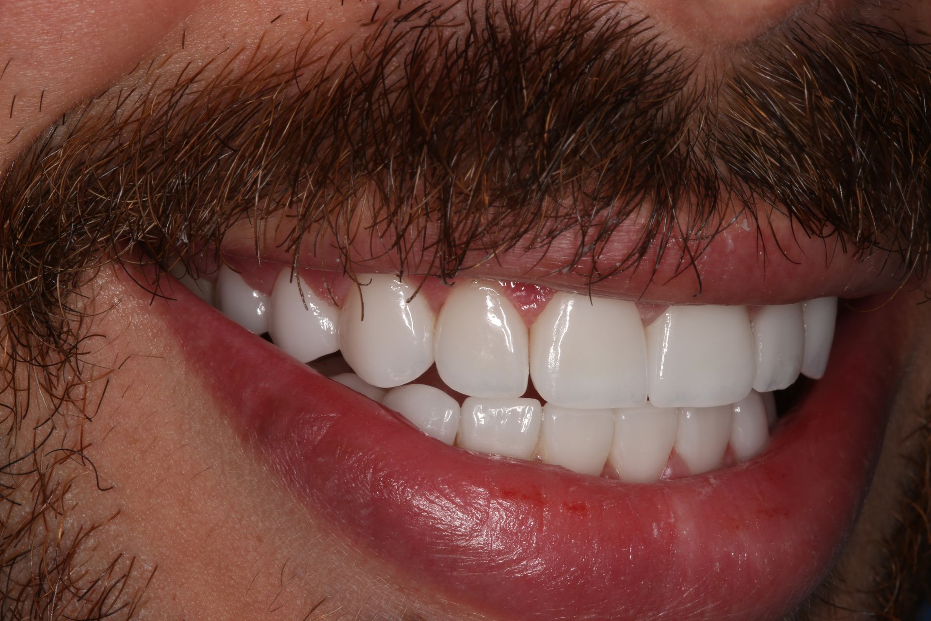 A close-up of a person with a mustache smiling to show off white, even teeth.